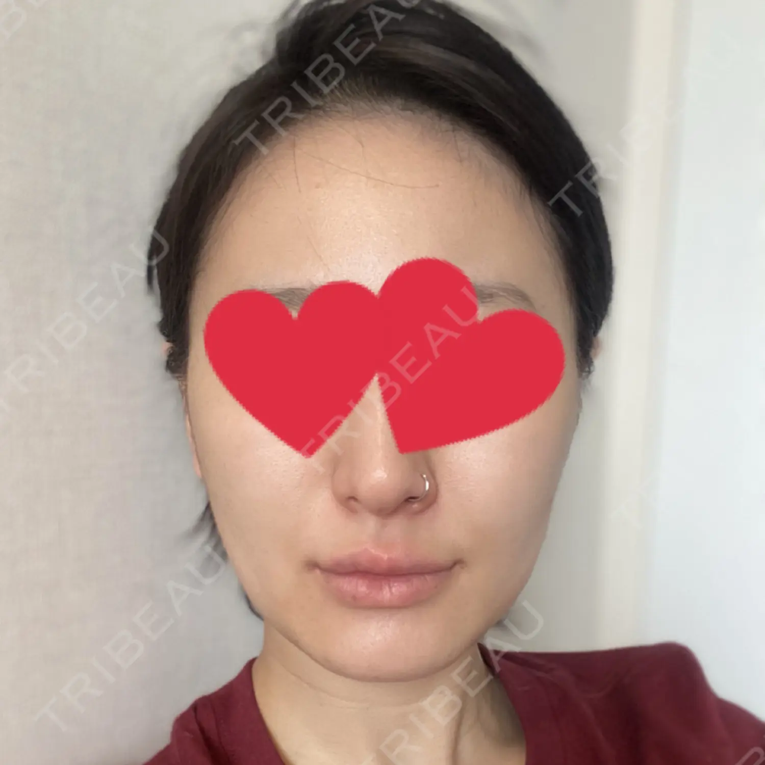 施術後の写真
