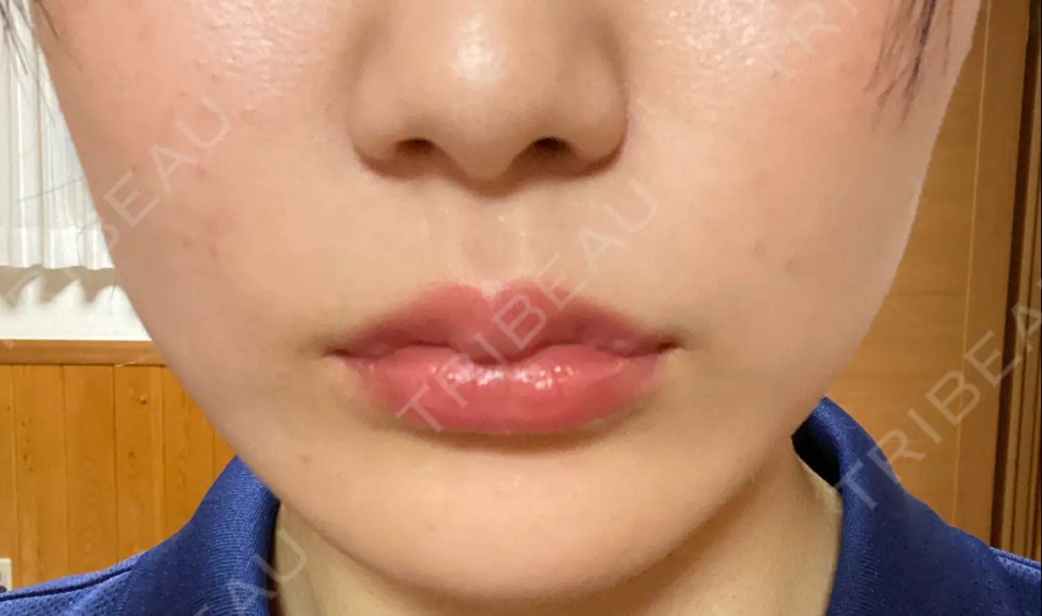 施術後の写真