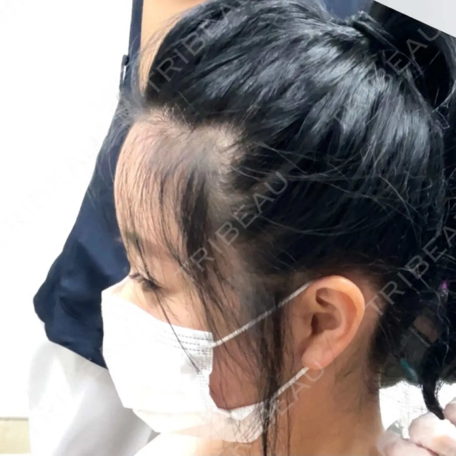 施術後の写真
