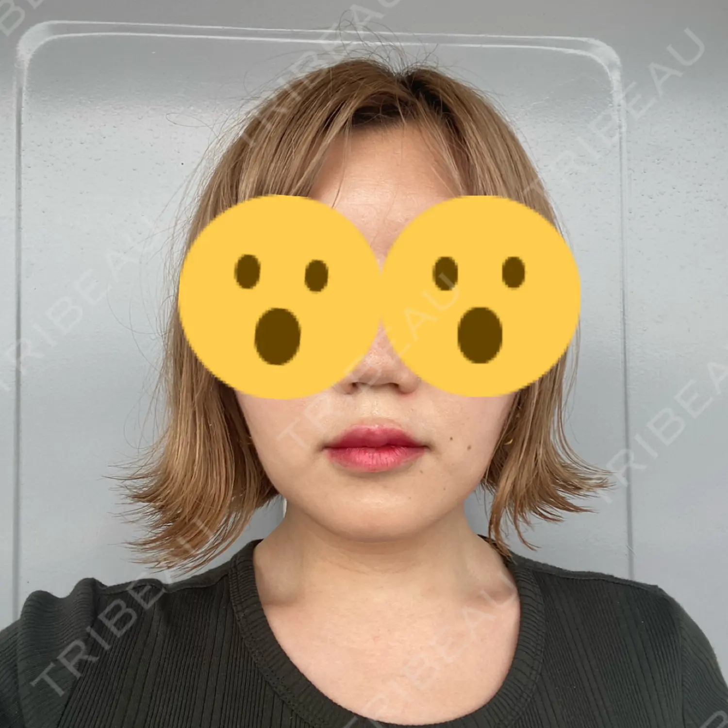 施術後の写真