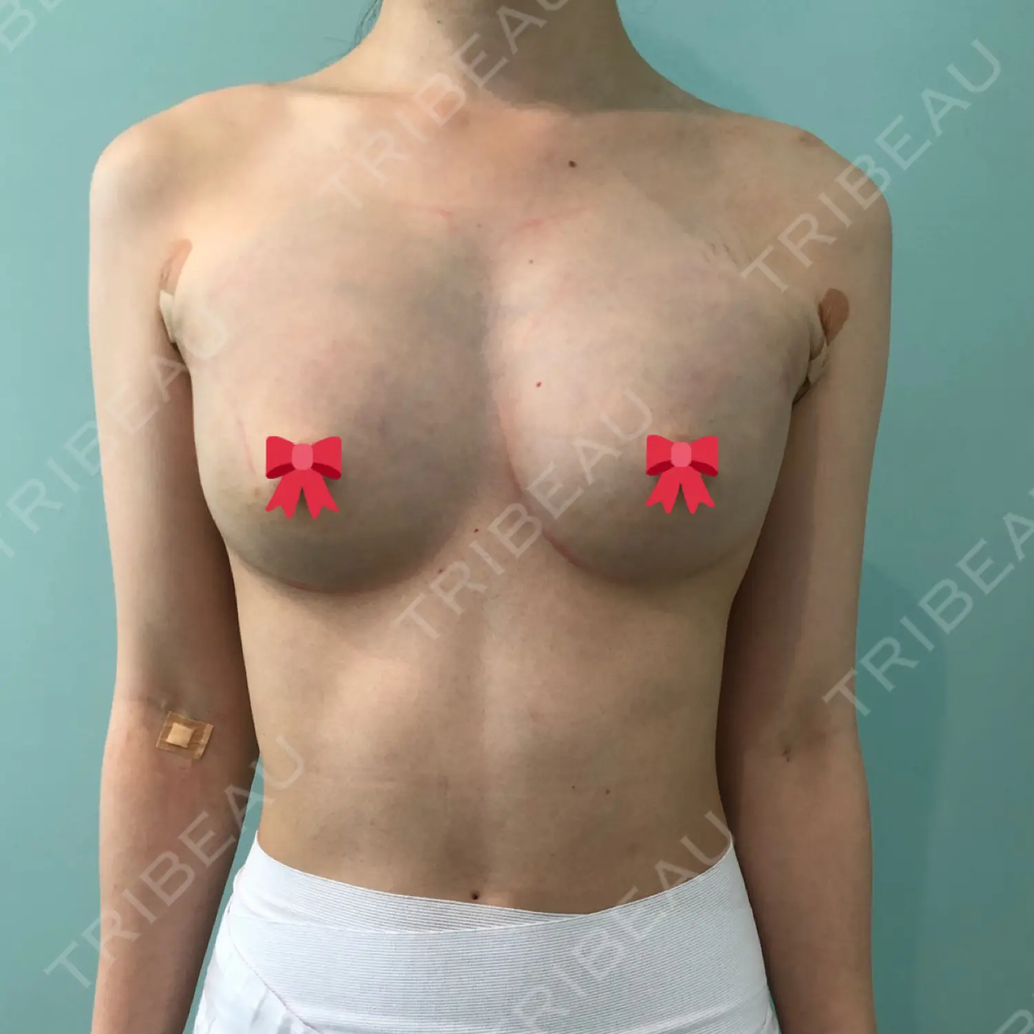 施術後の写真