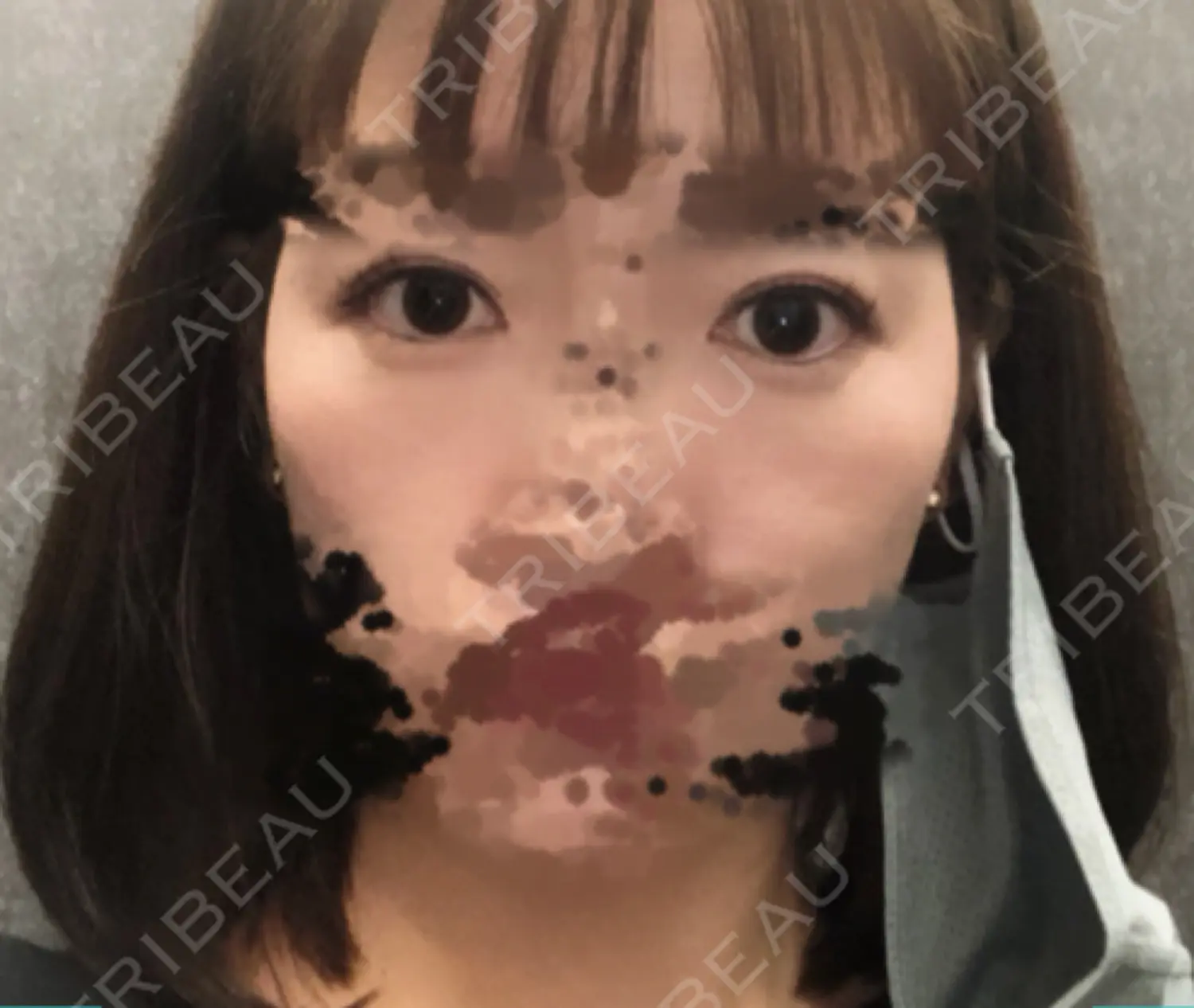 施術後の写真