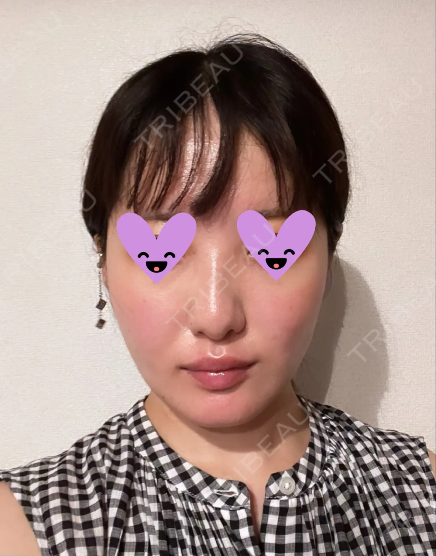 施術後の写真