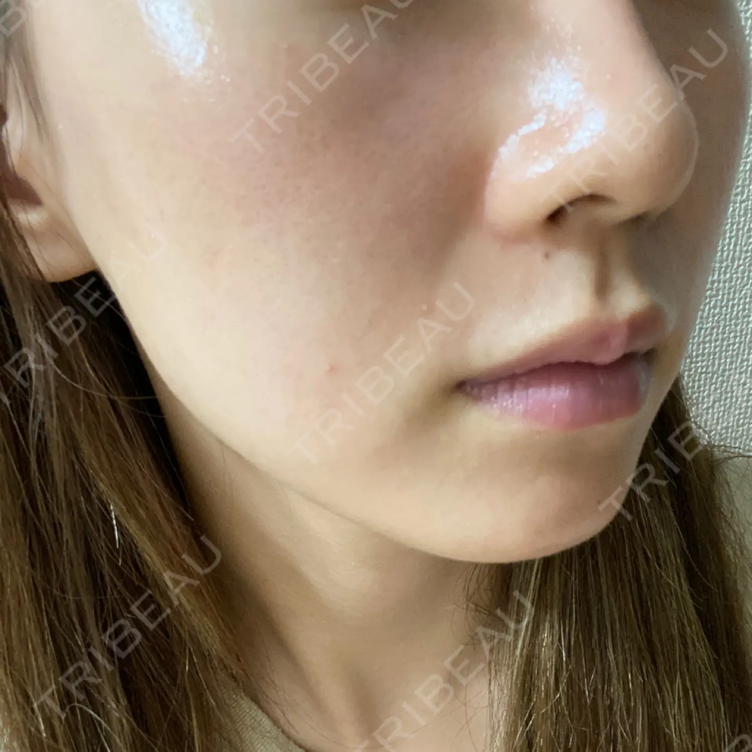 施術後の写真