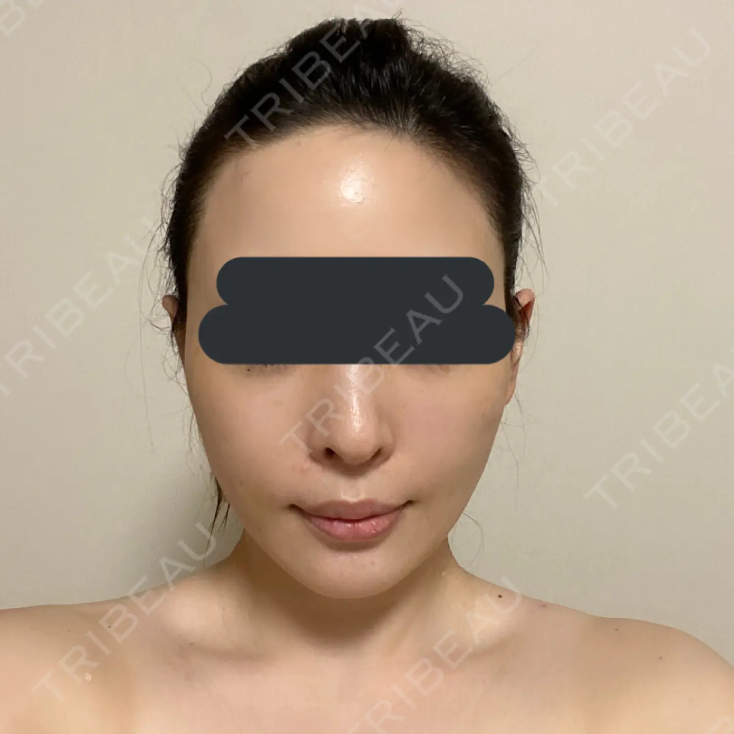施術後の写真