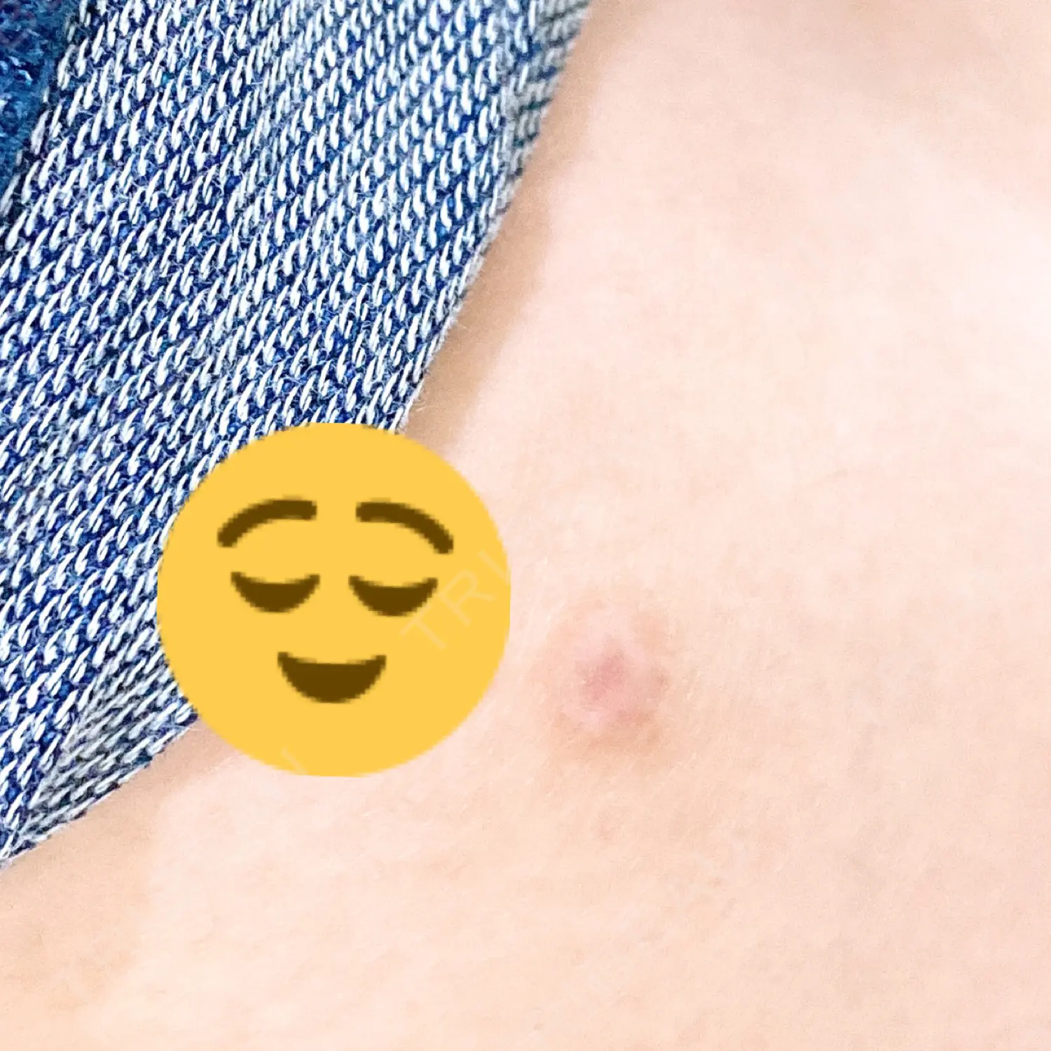 施術後の写真