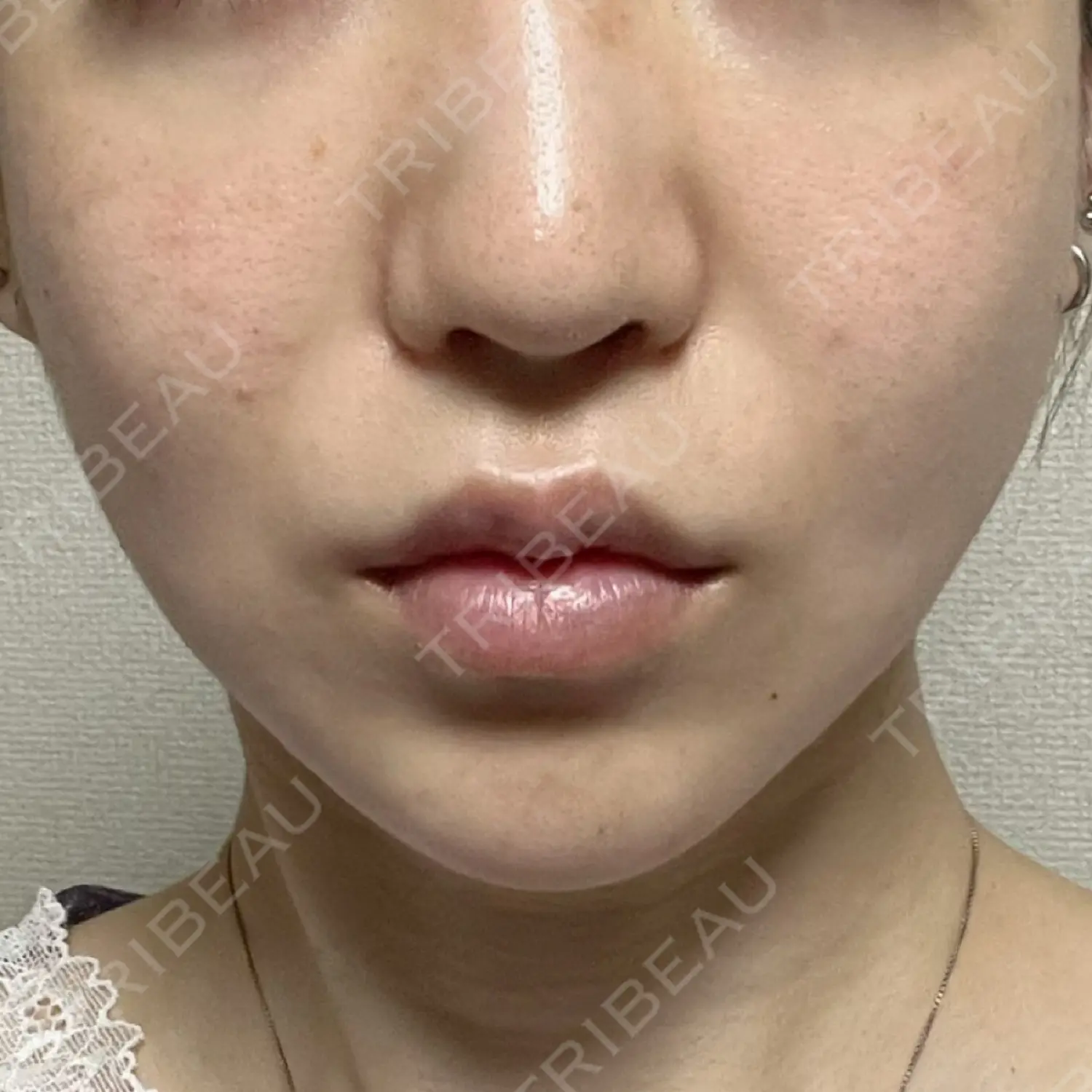 施術後の写真