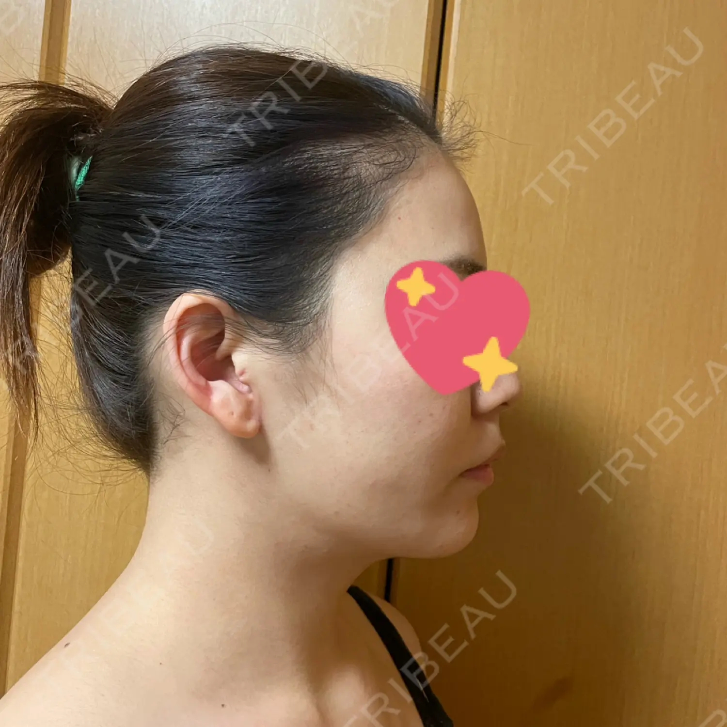 施術後の写真