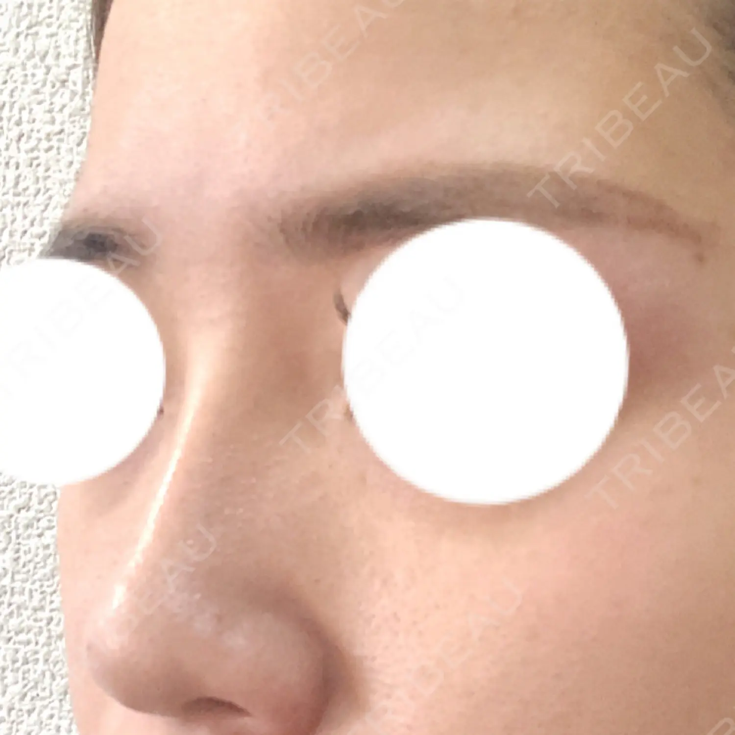 施術後の写真