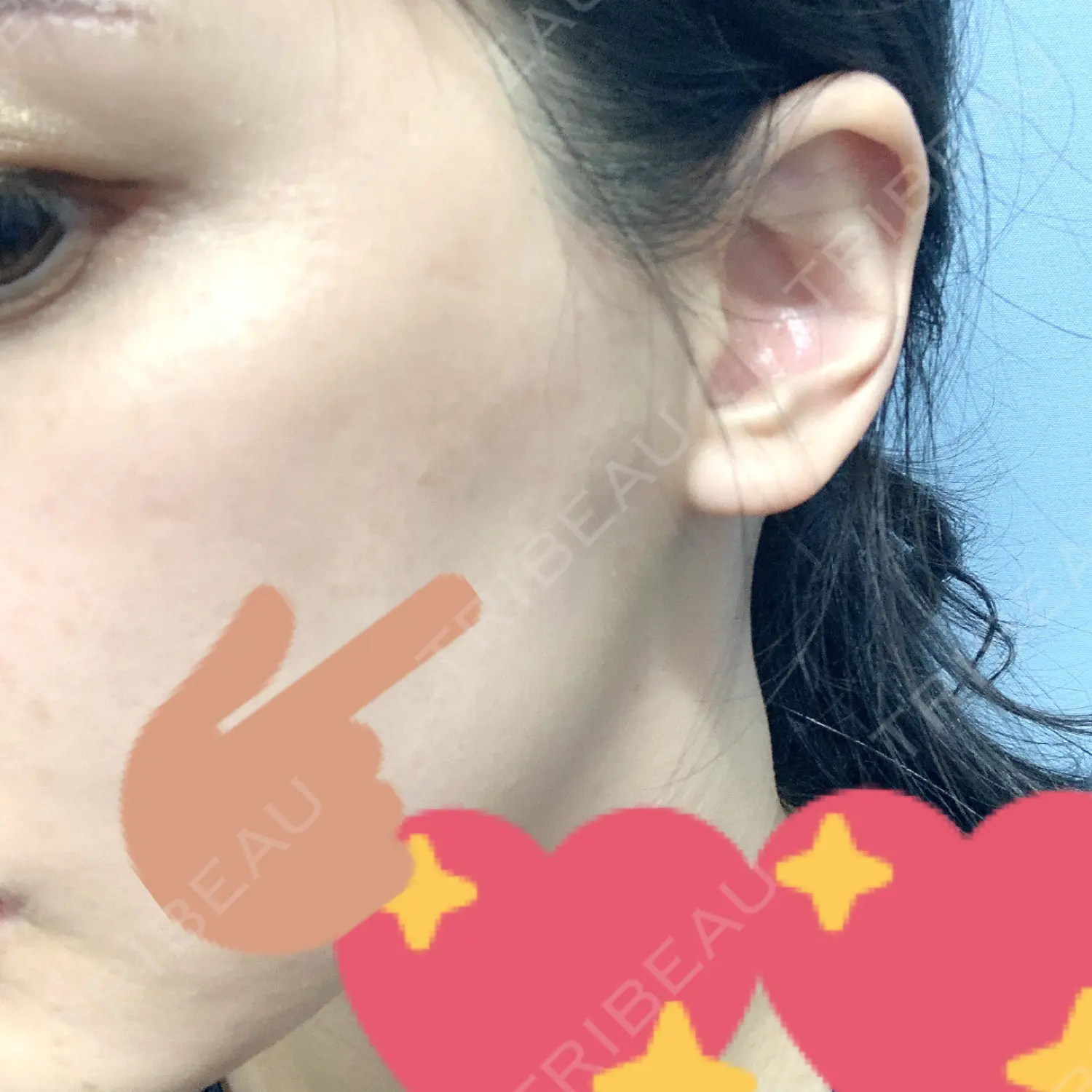 施術後の写真