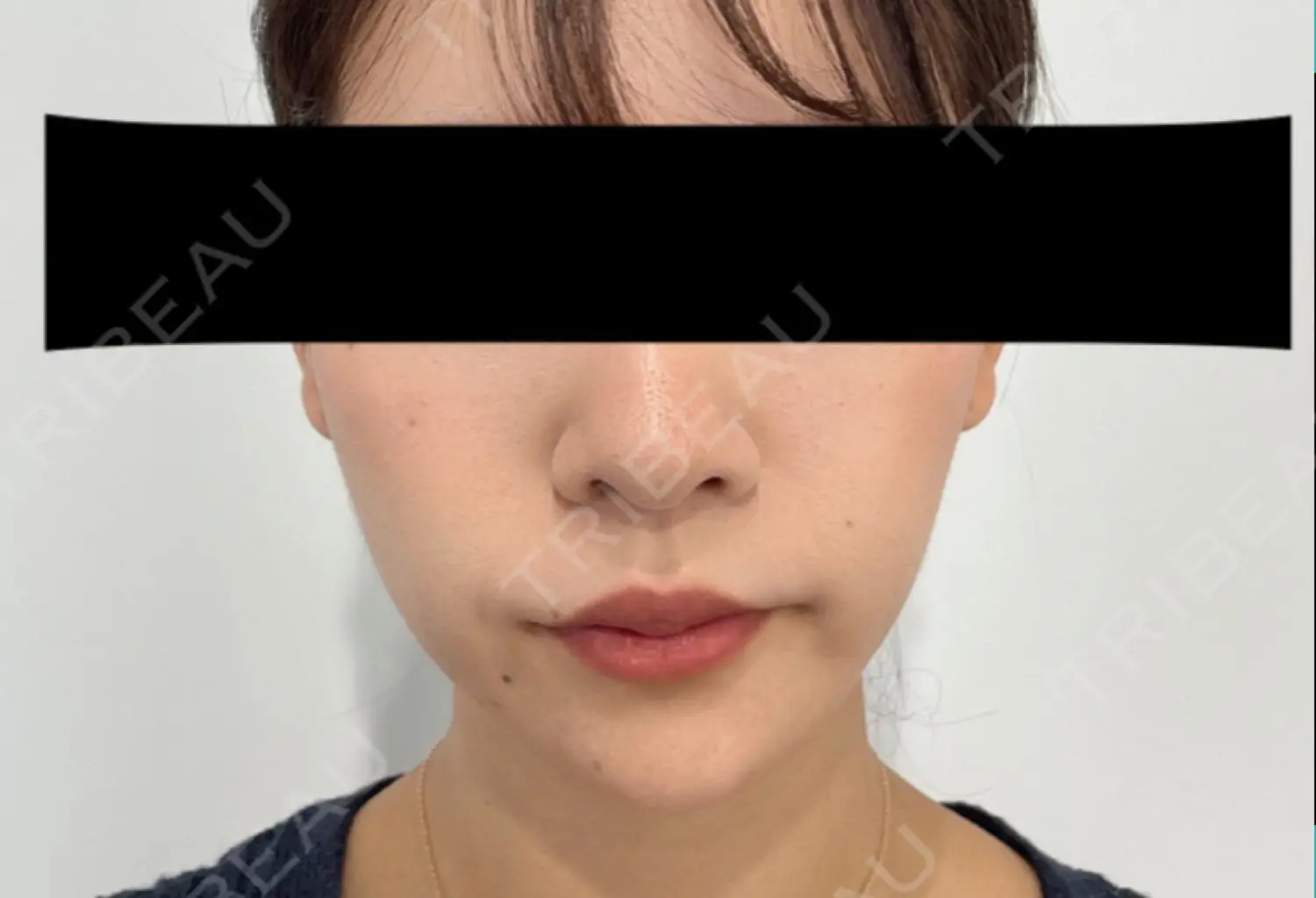 施術後の写真