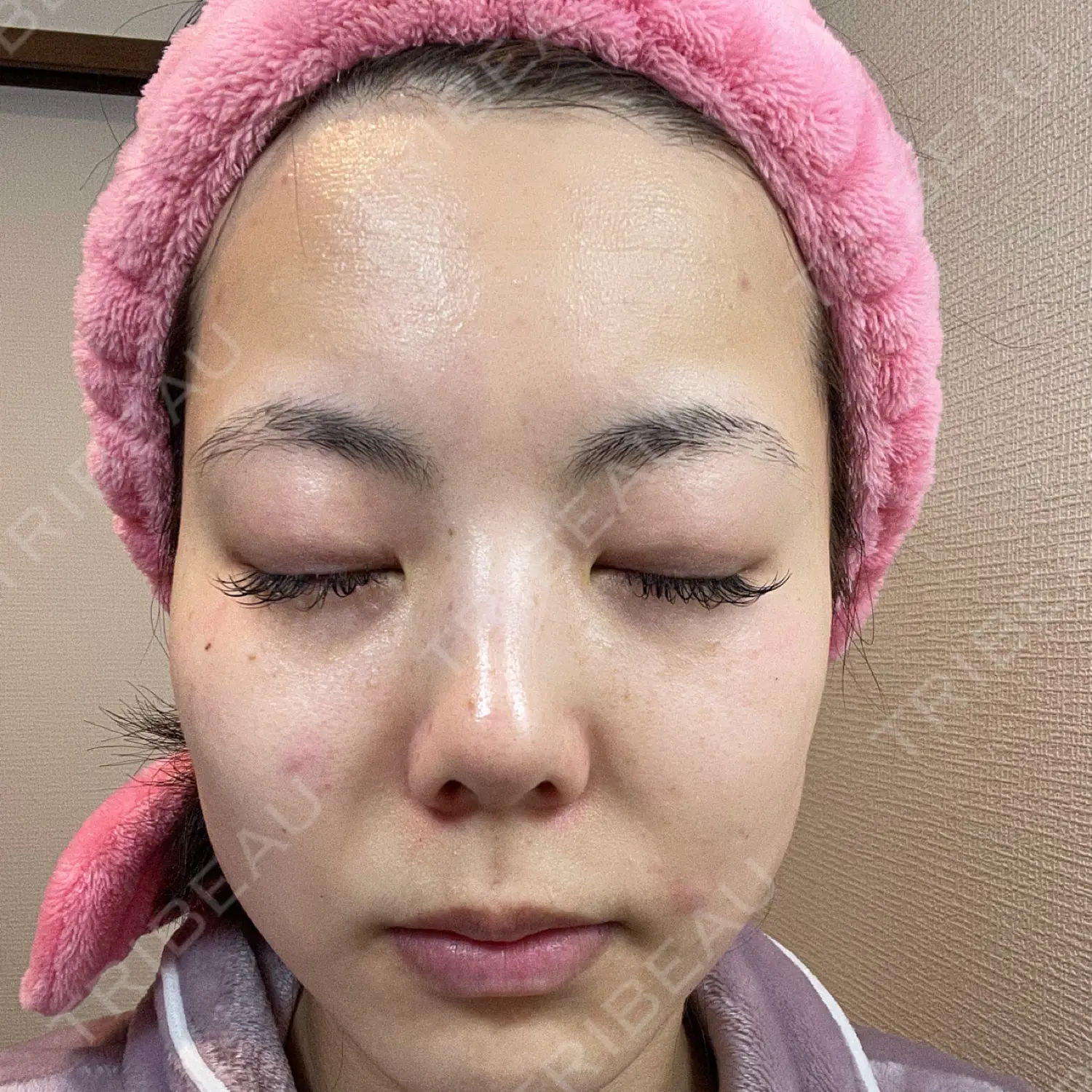 施術後の写真