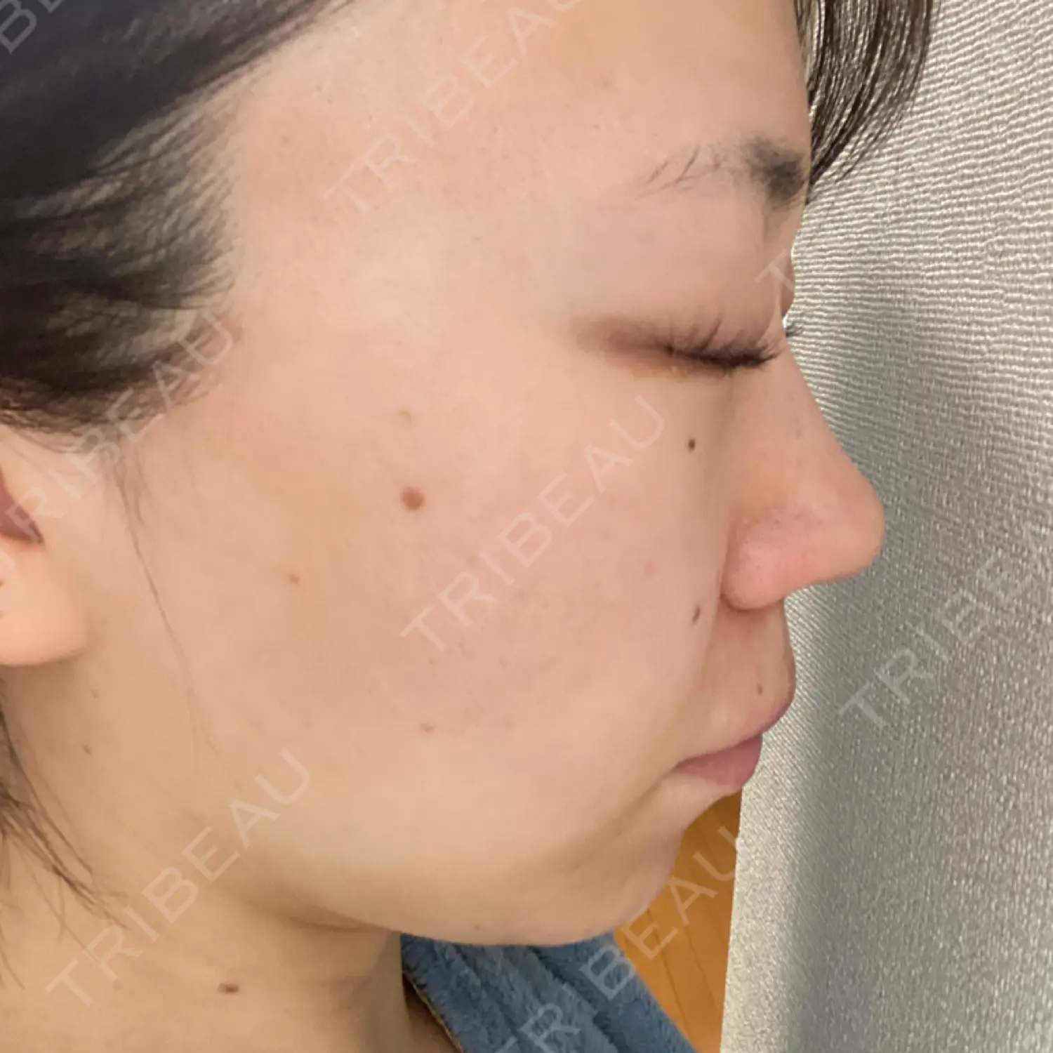 施術後の写真