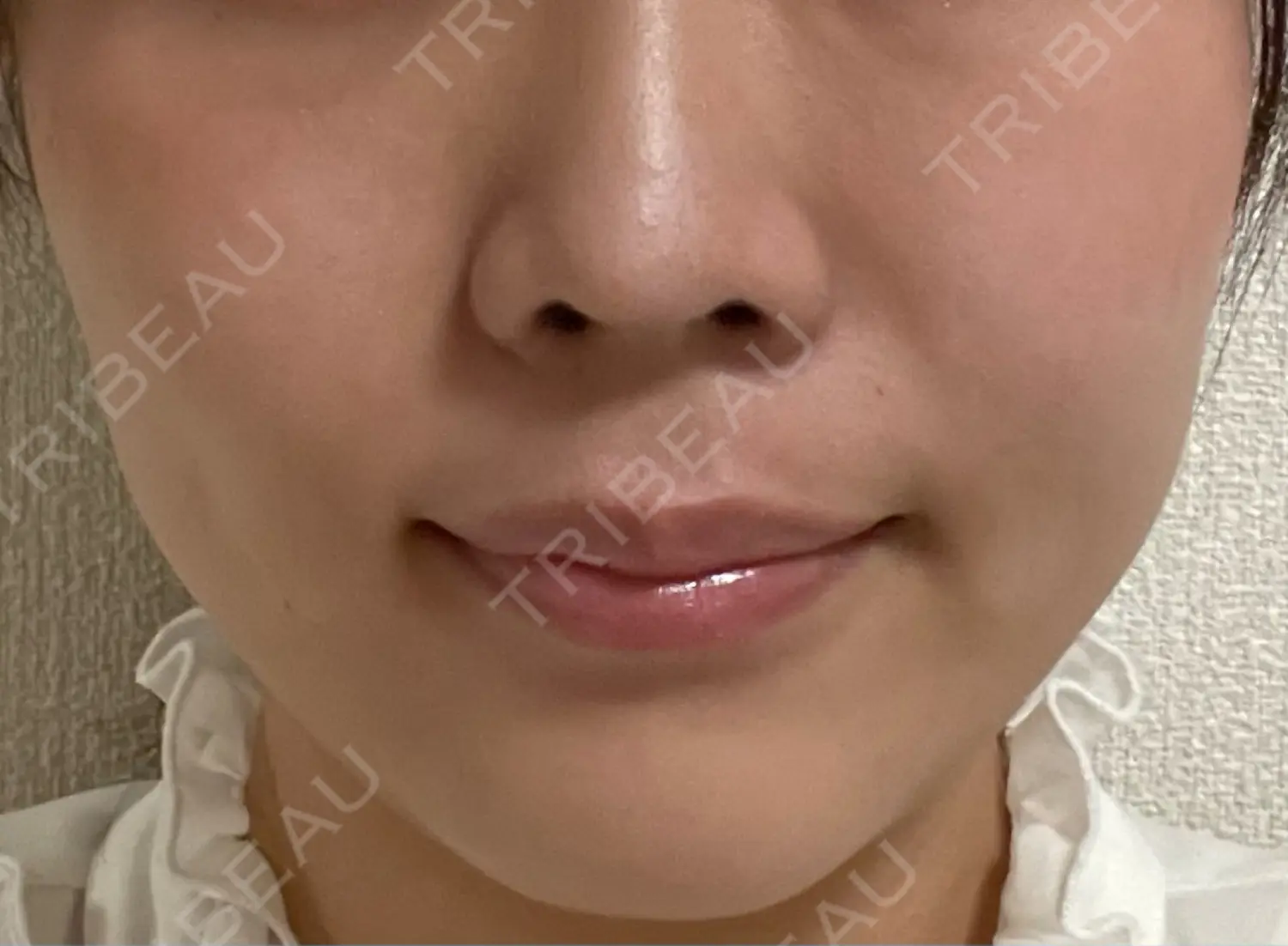 施術後の写真