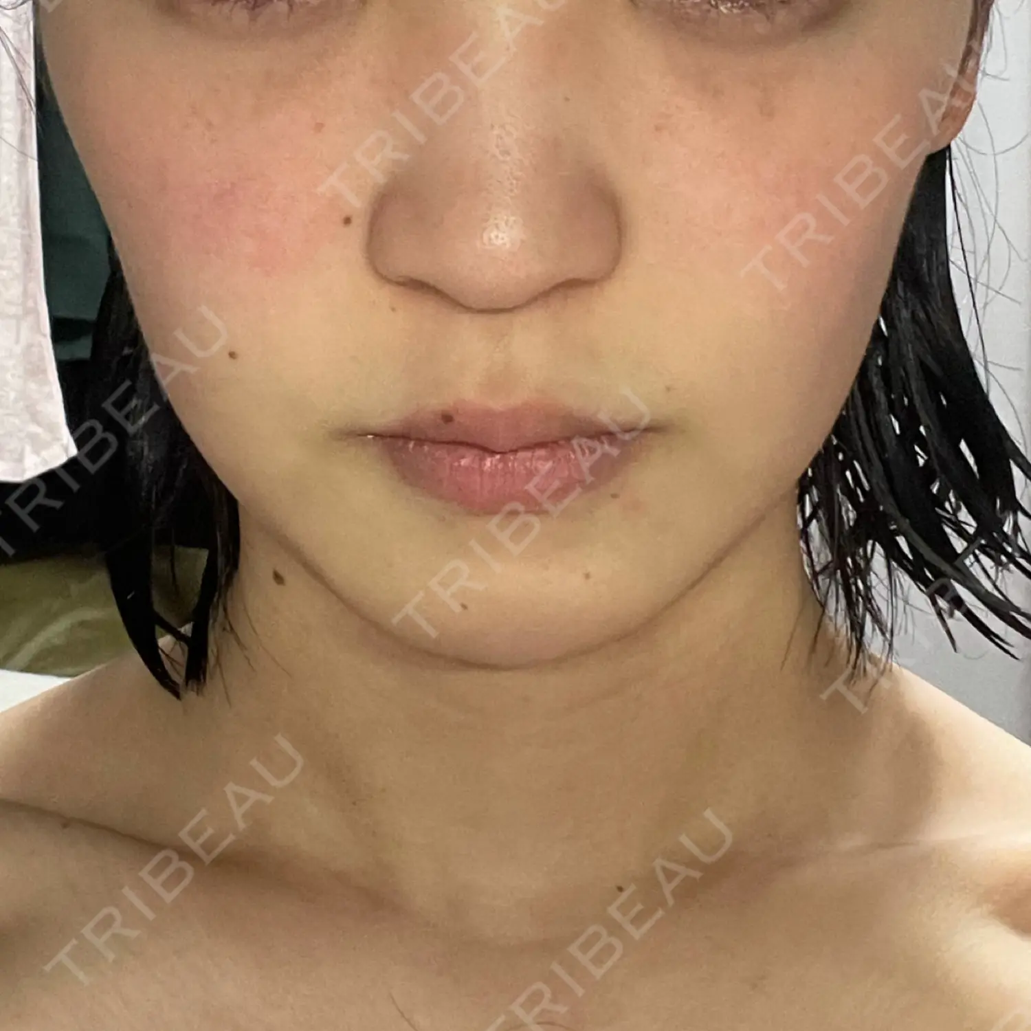 施術後の写真