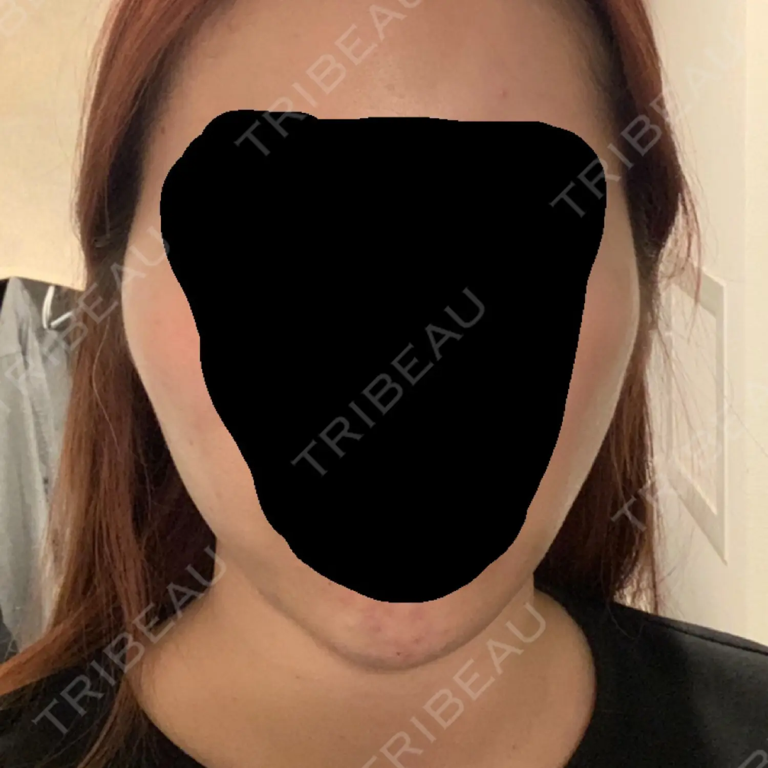 施術後の写真