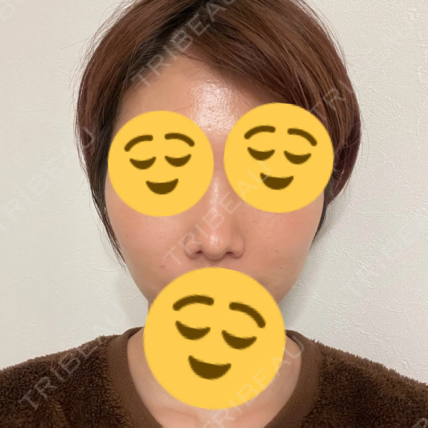 施術後の写真