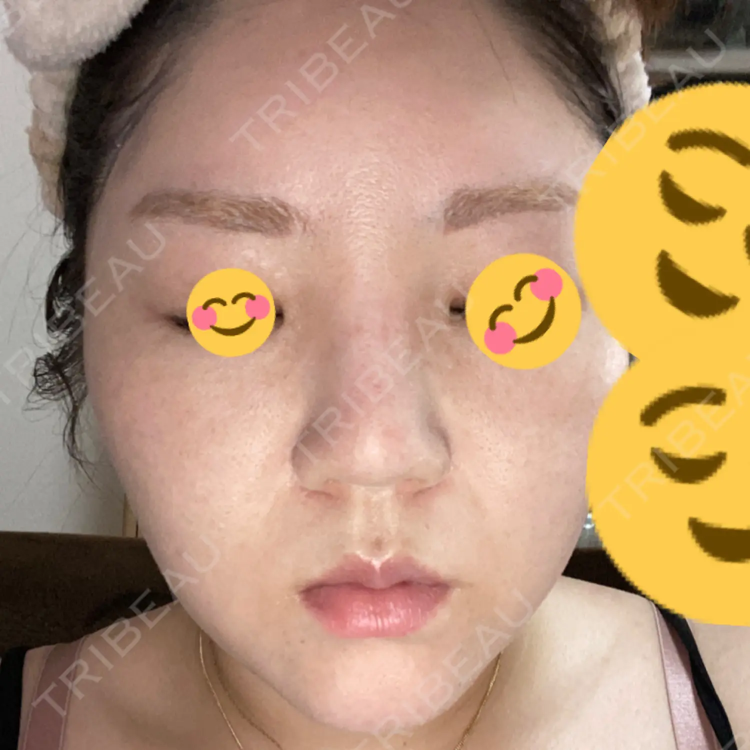 施術後の写真