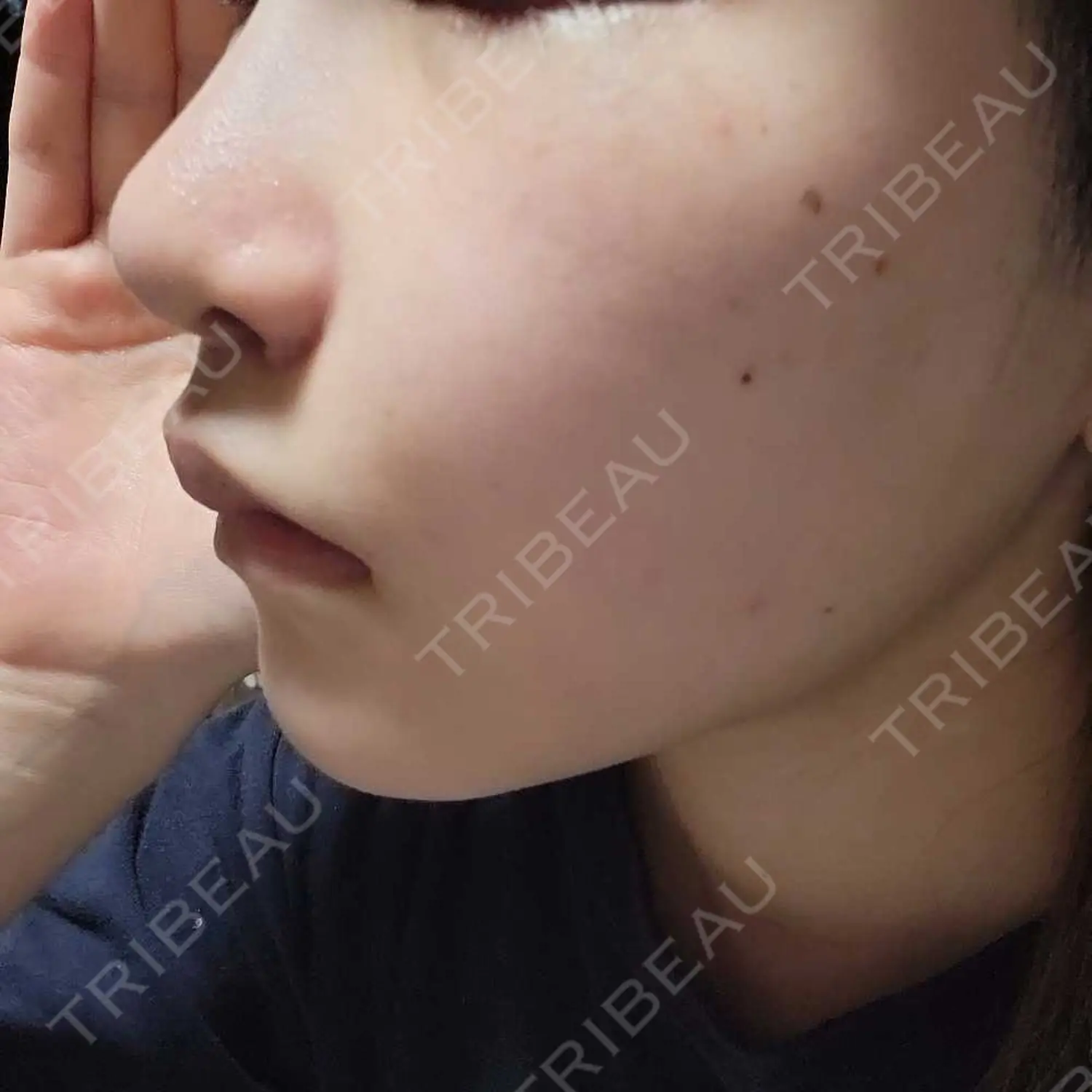 施術後の写真