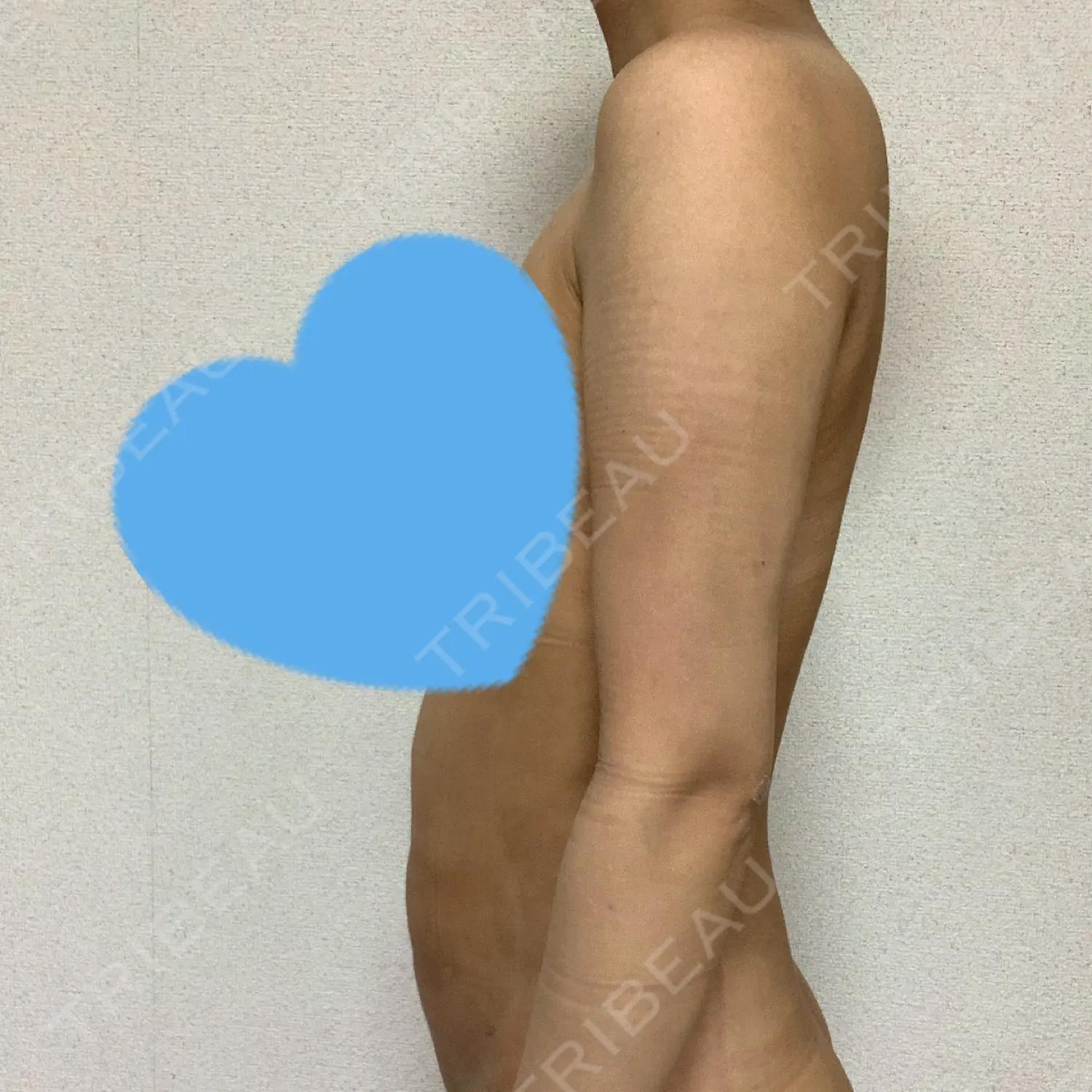 施術後の写真
