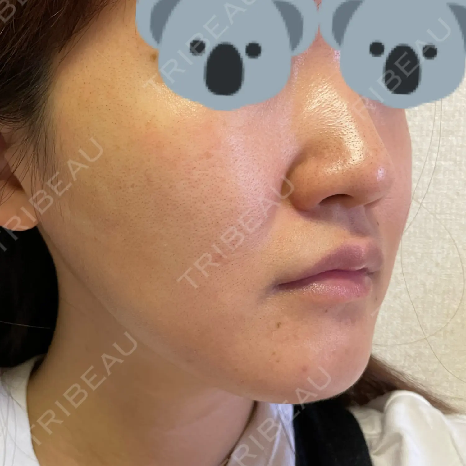施術後の写真