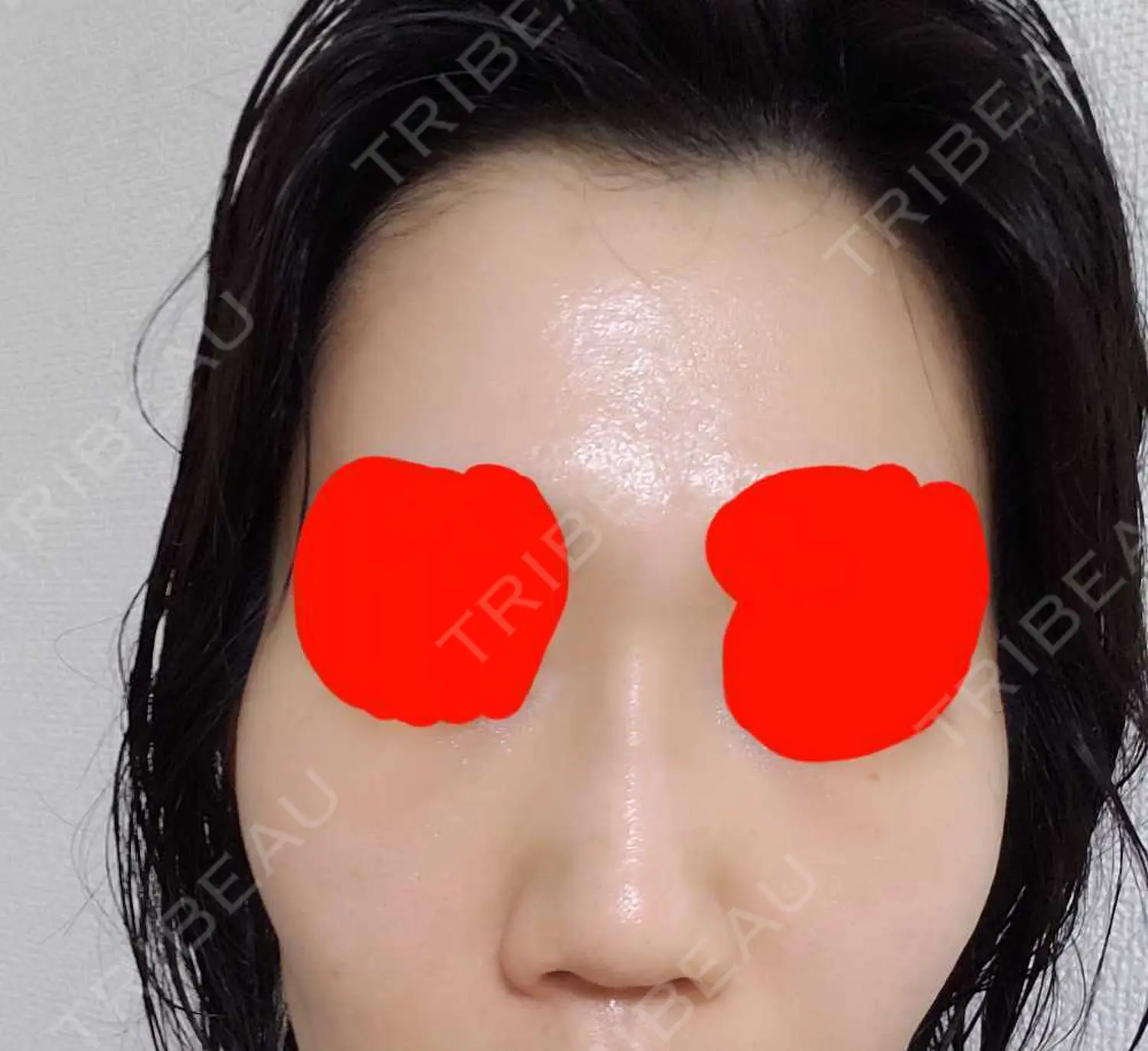 施術後の写真