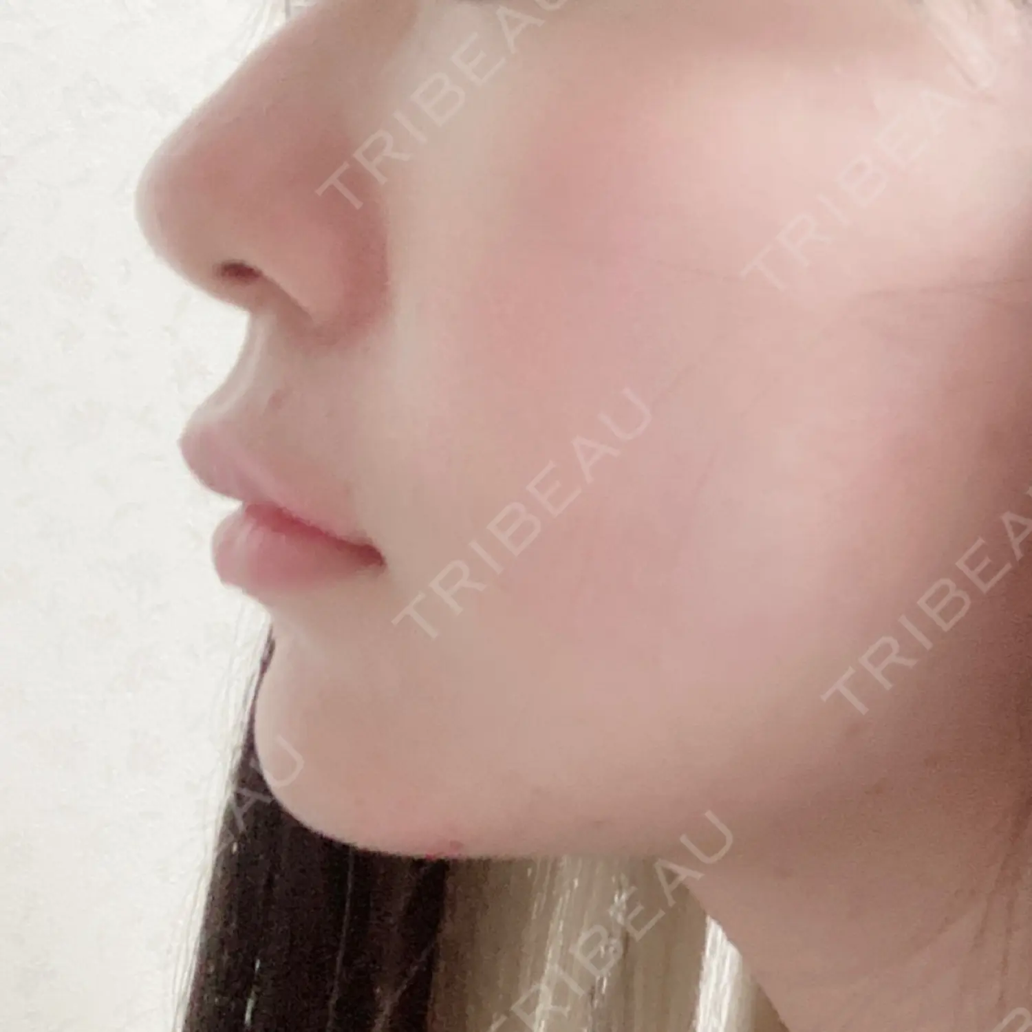 施術後の写真