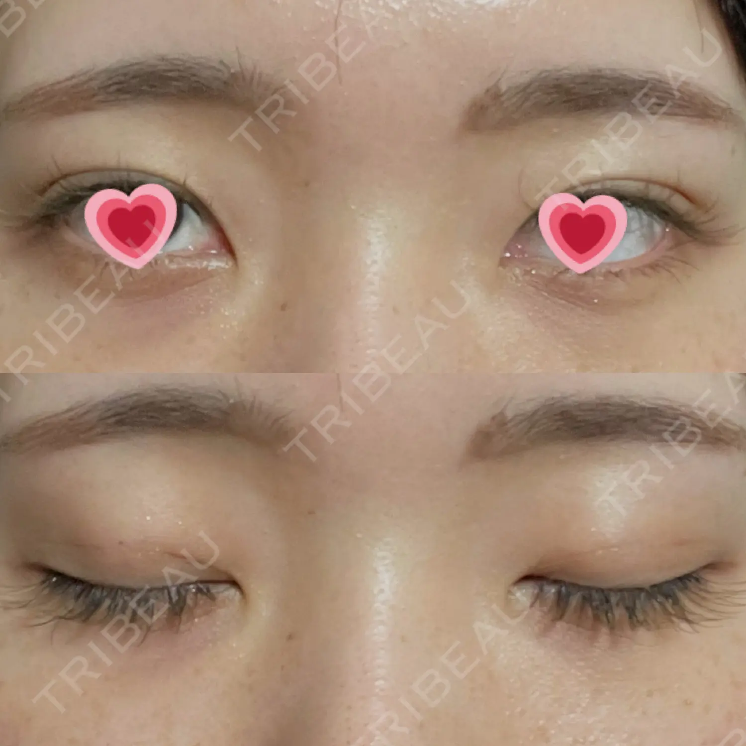 施術後の写真