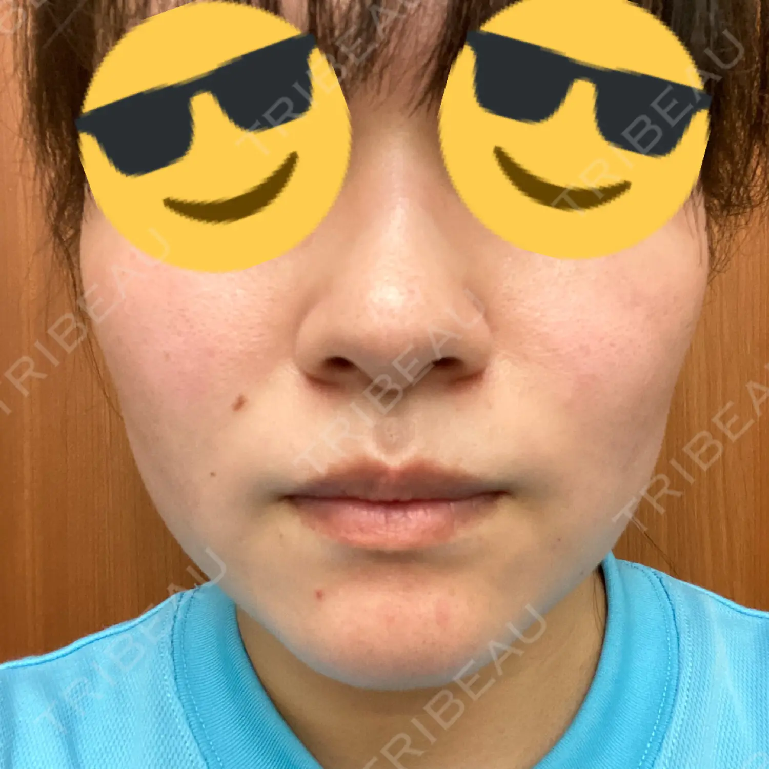 施術後の写真