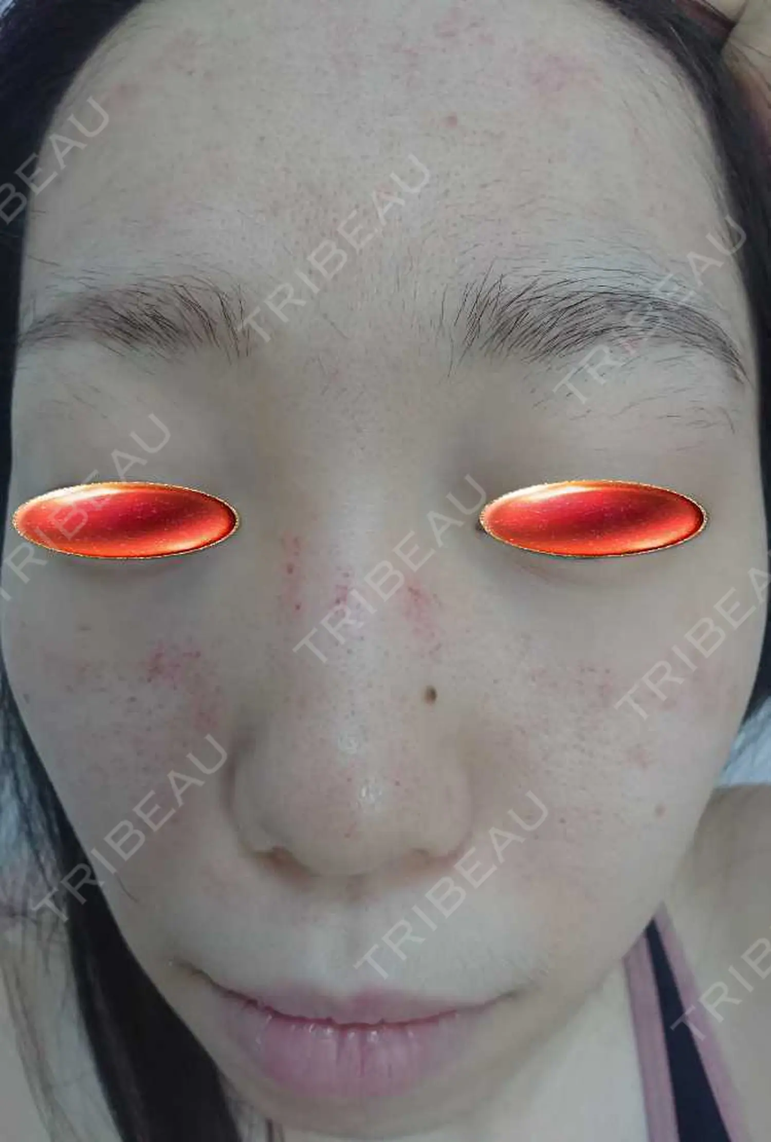 施術後の写真