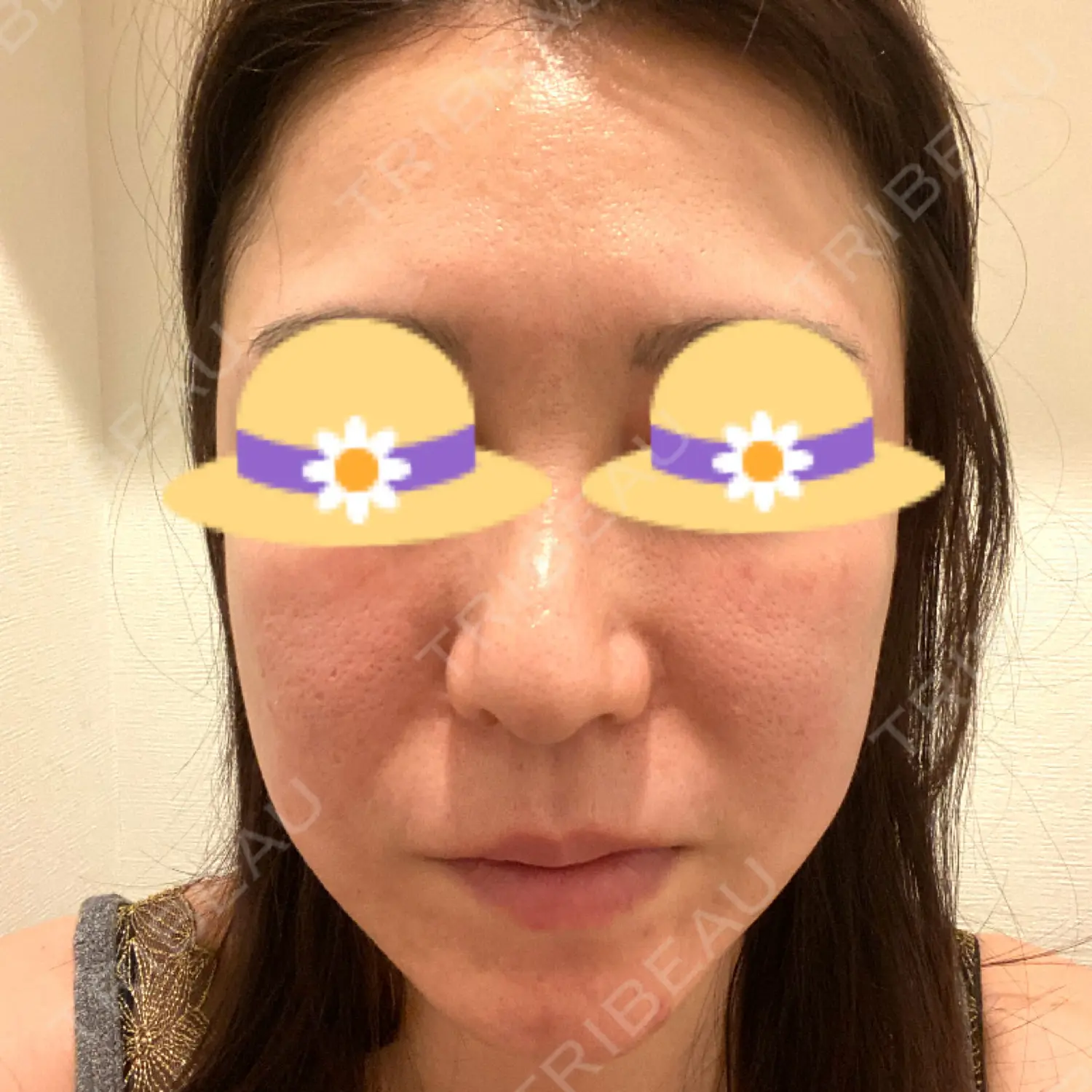 施術後の写真