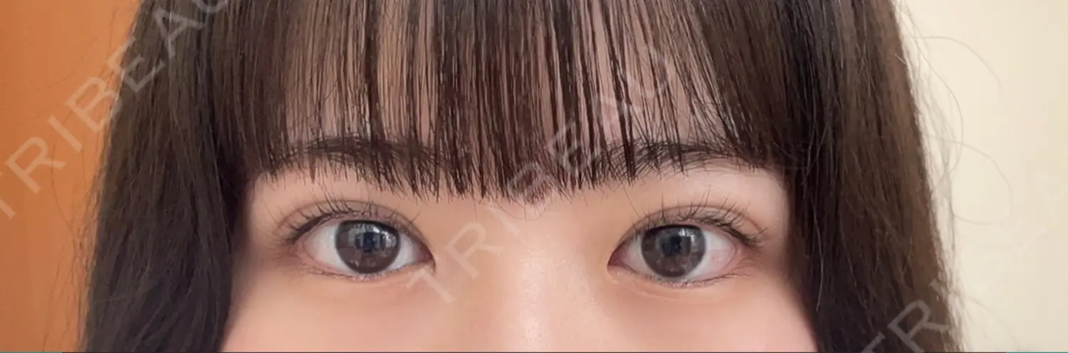 施術後の写真