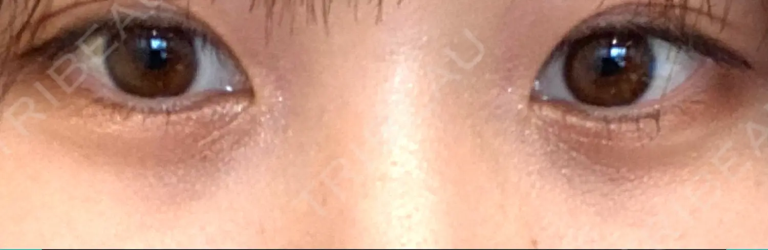 施術後の写真