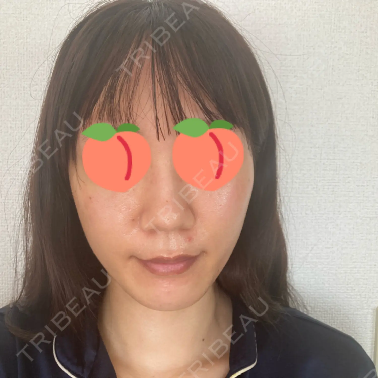施術後の写真