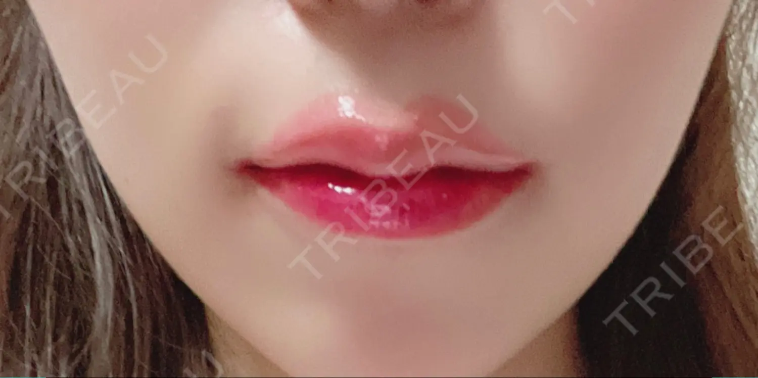 施術後の写真