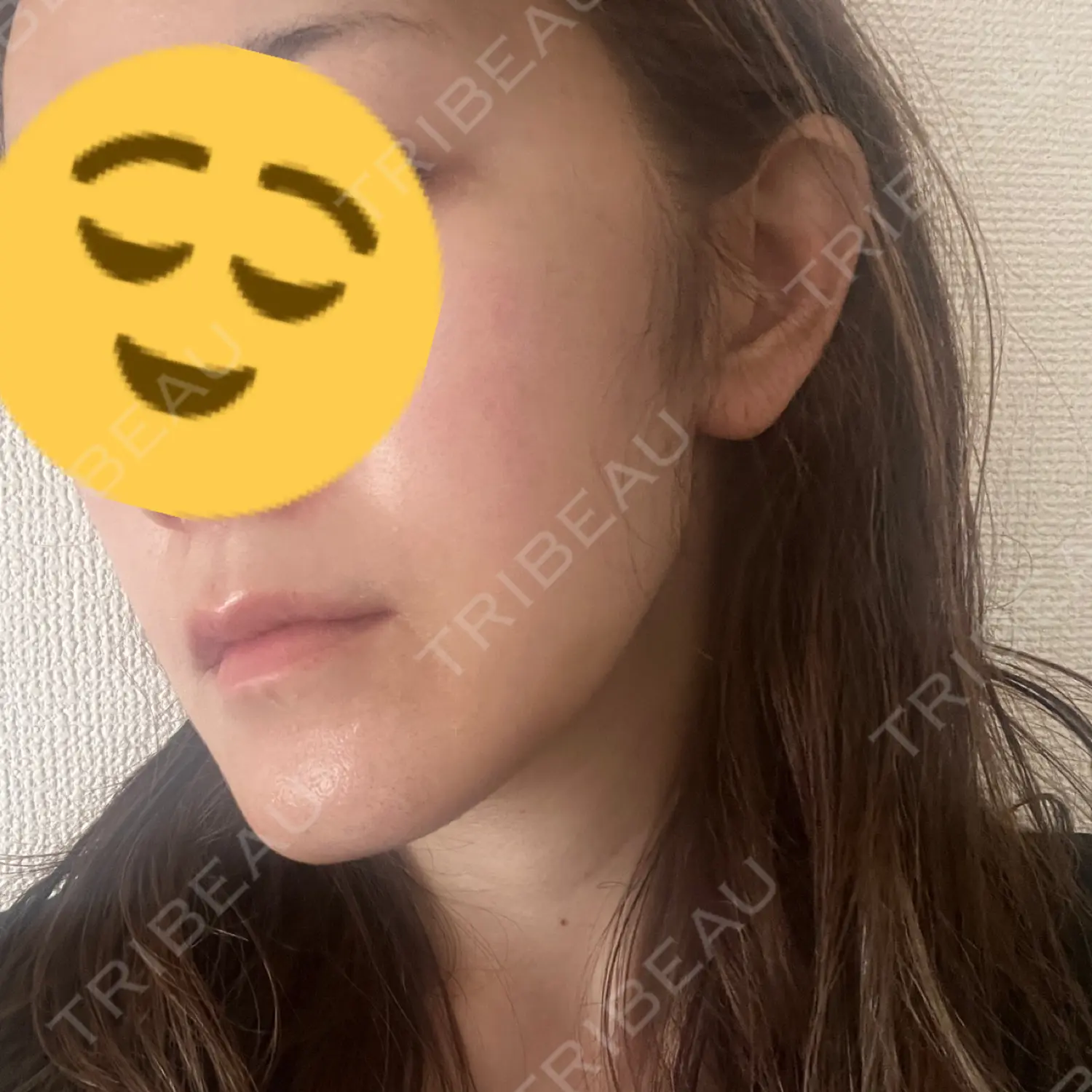 施術後の写真
