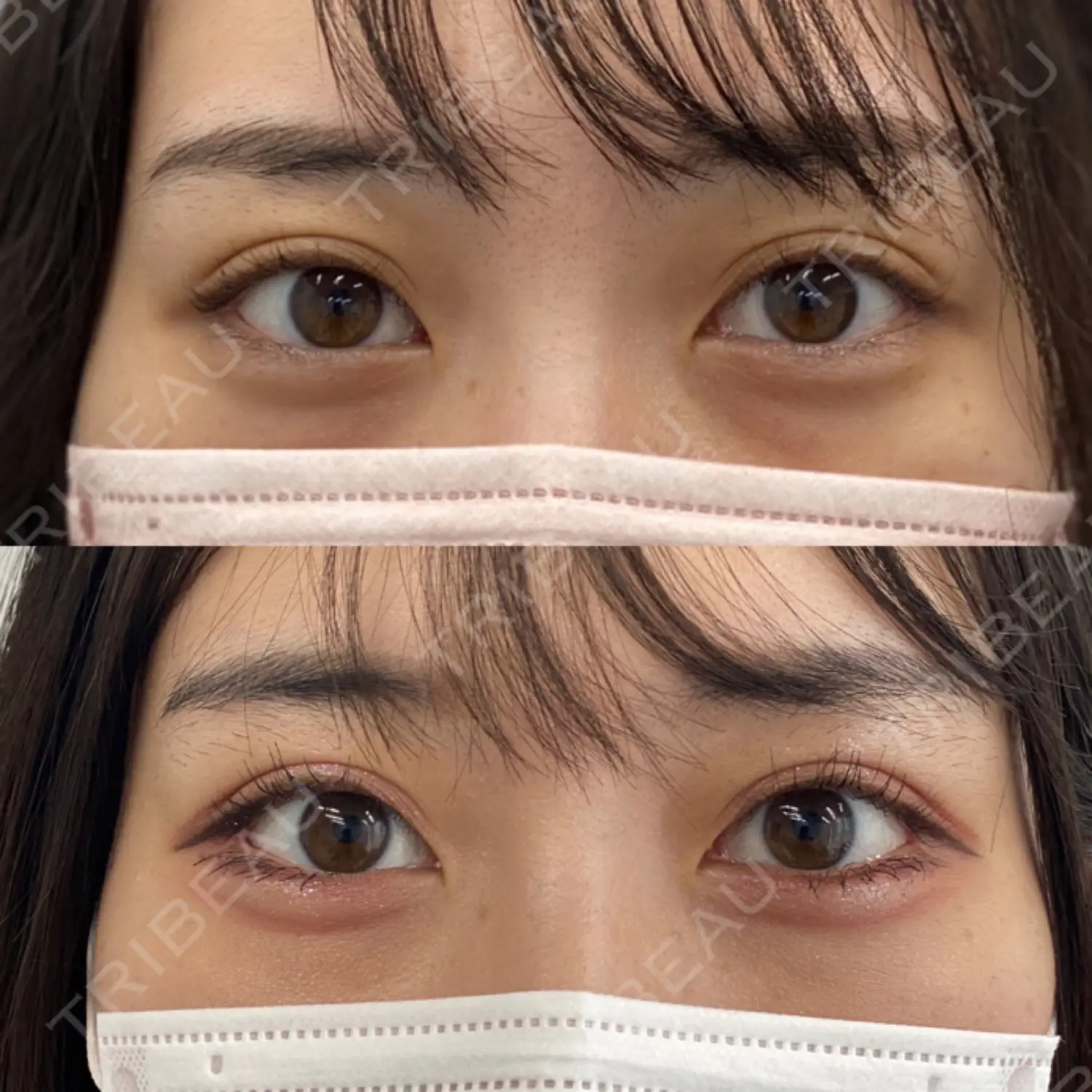 施術後の写真