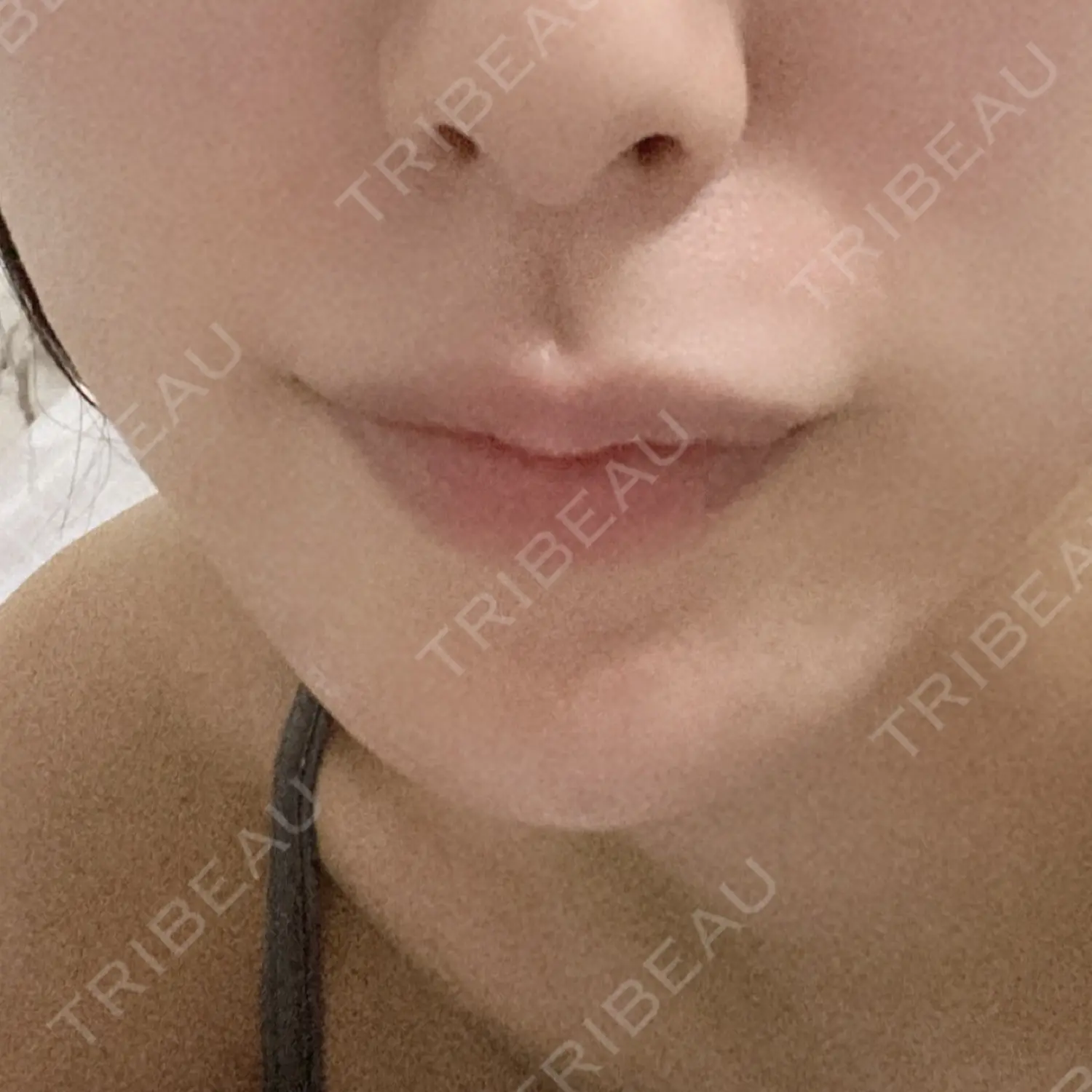 施術後の写真