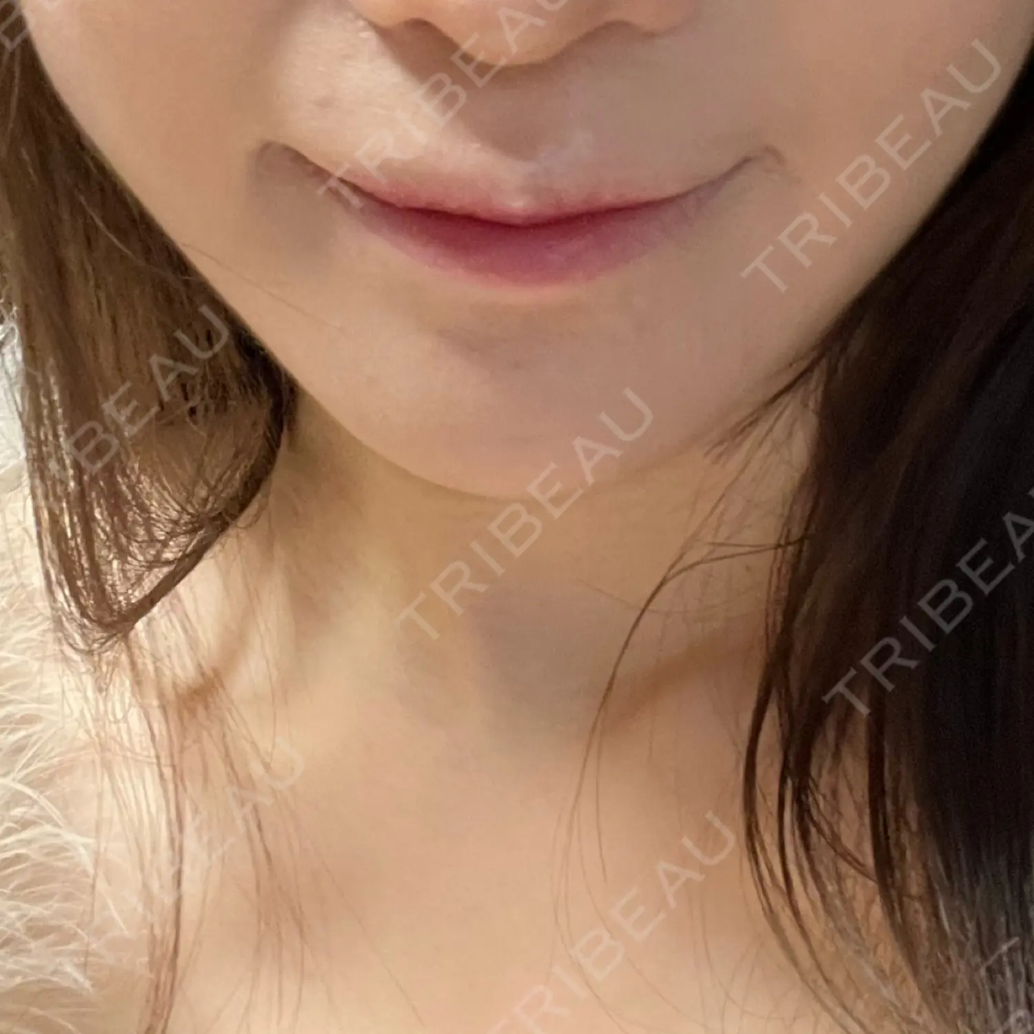 施術後の写真
