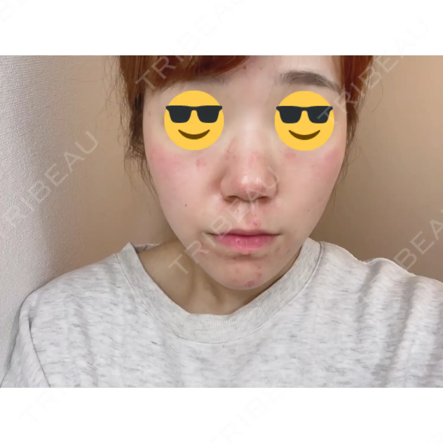 施術後の写真