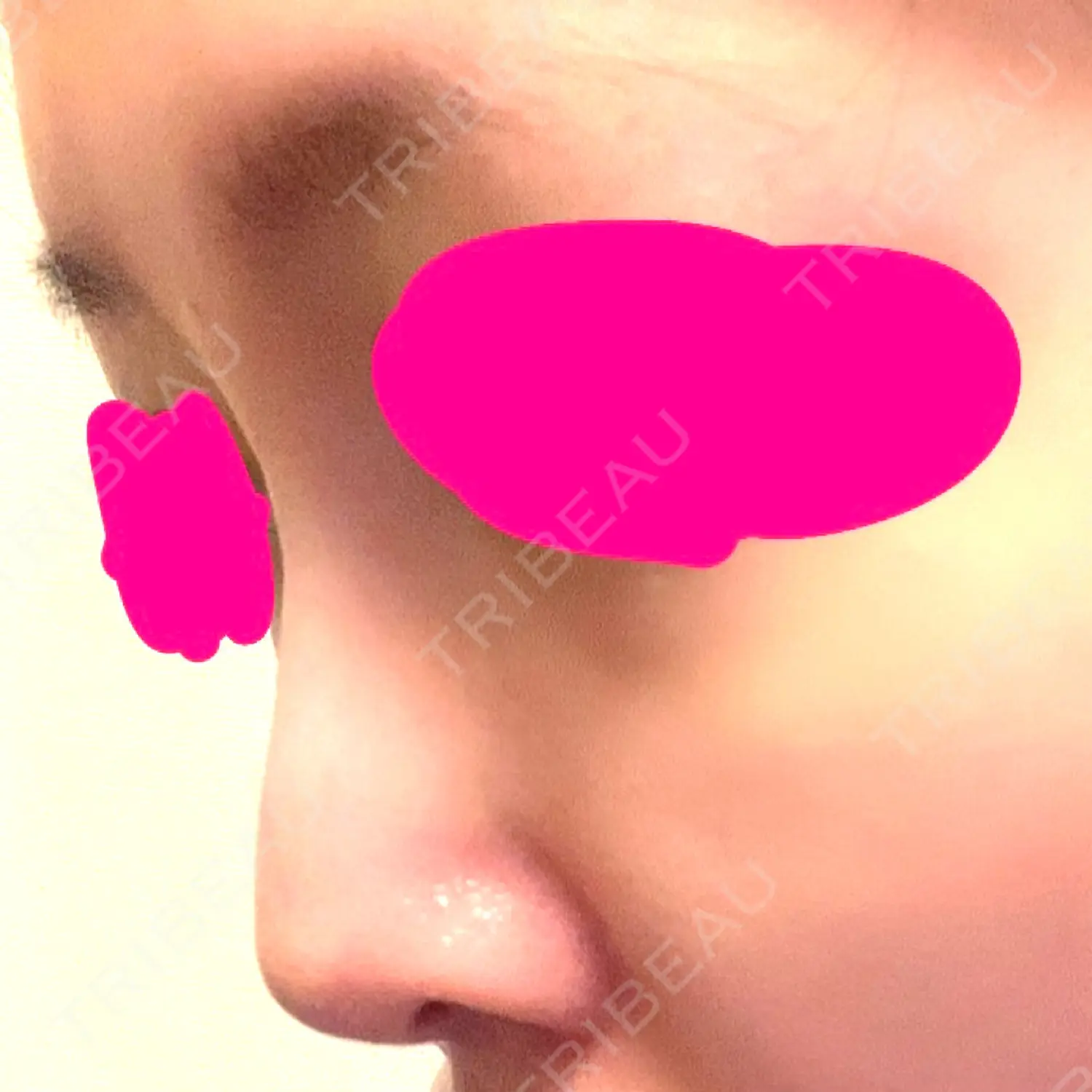 施術後の写真