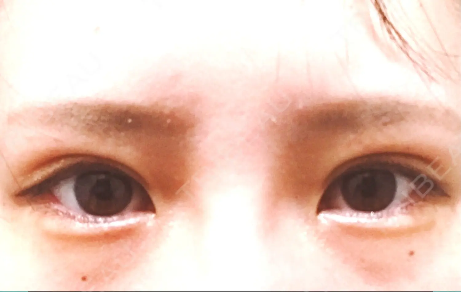 施術後の写真