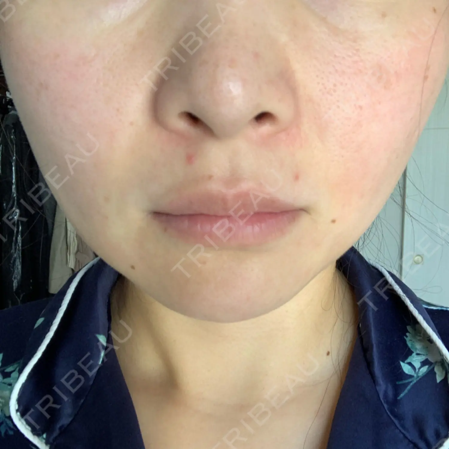 施術後の写真