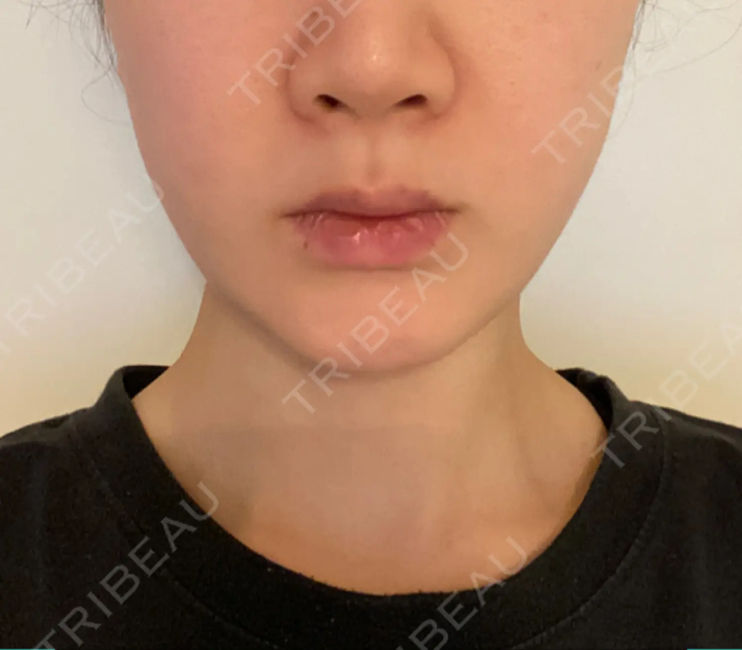 施術後の写真