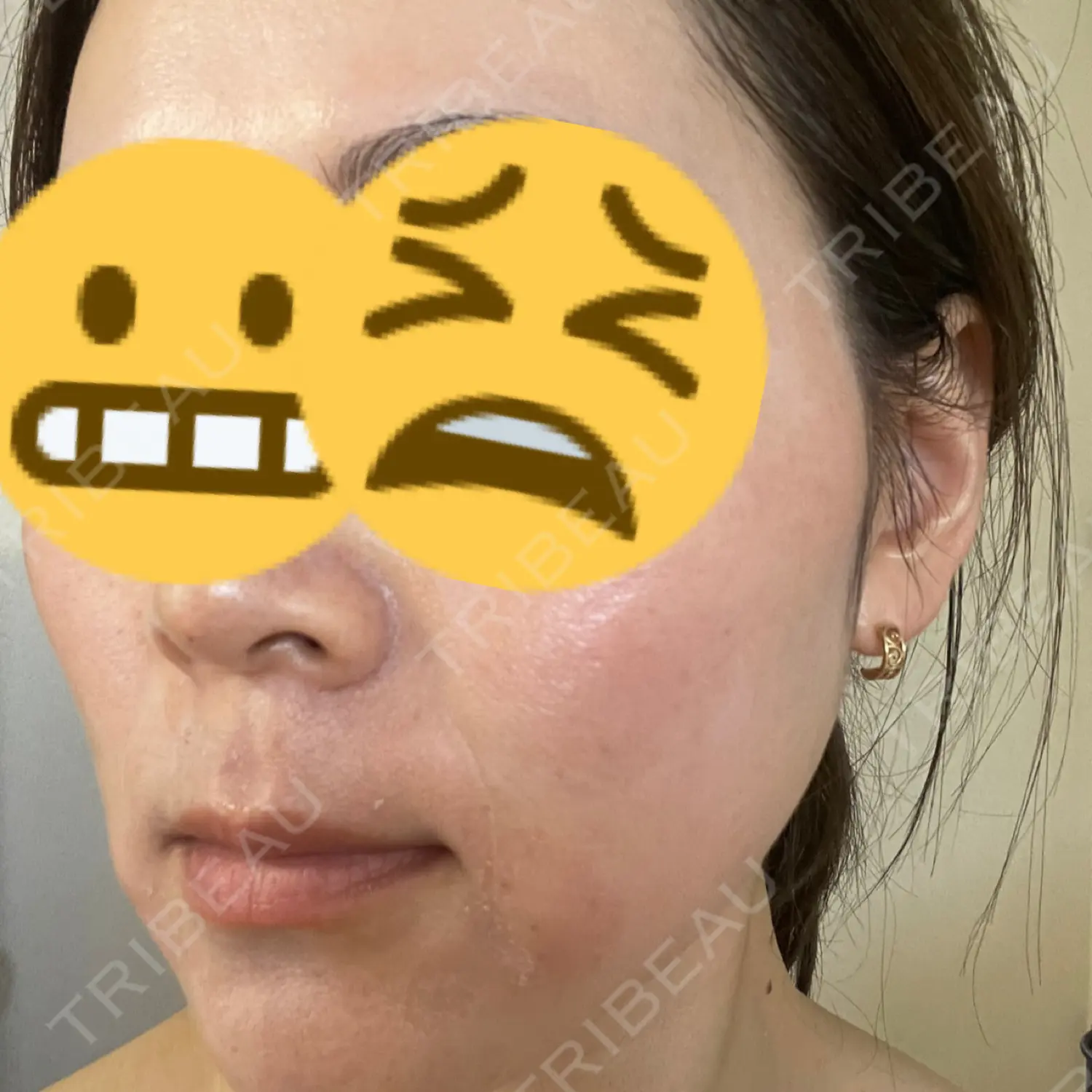 施術後の写真