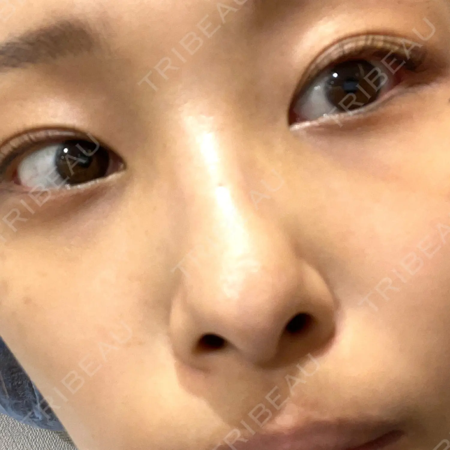 施術後の写真