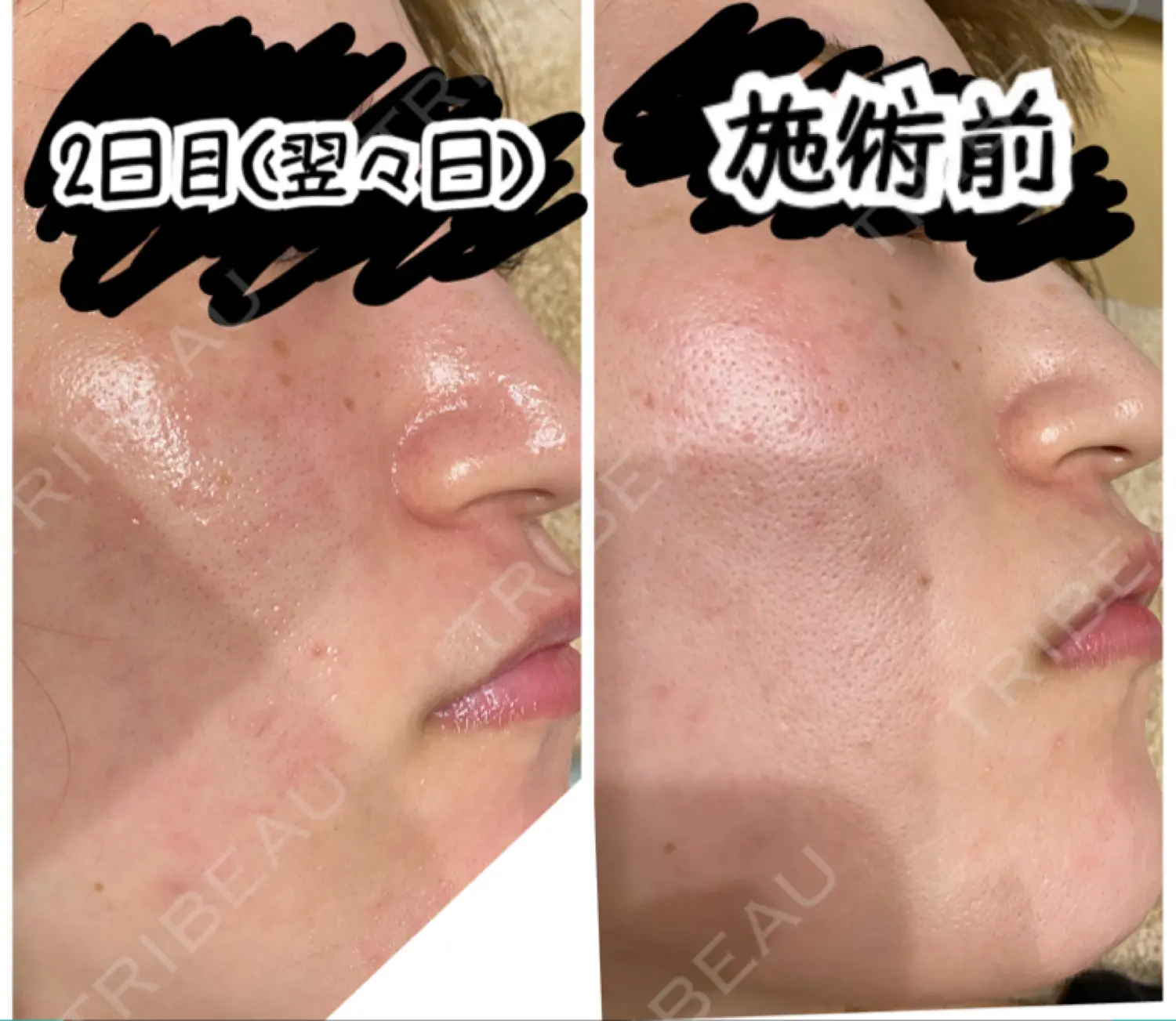 施術後の写真