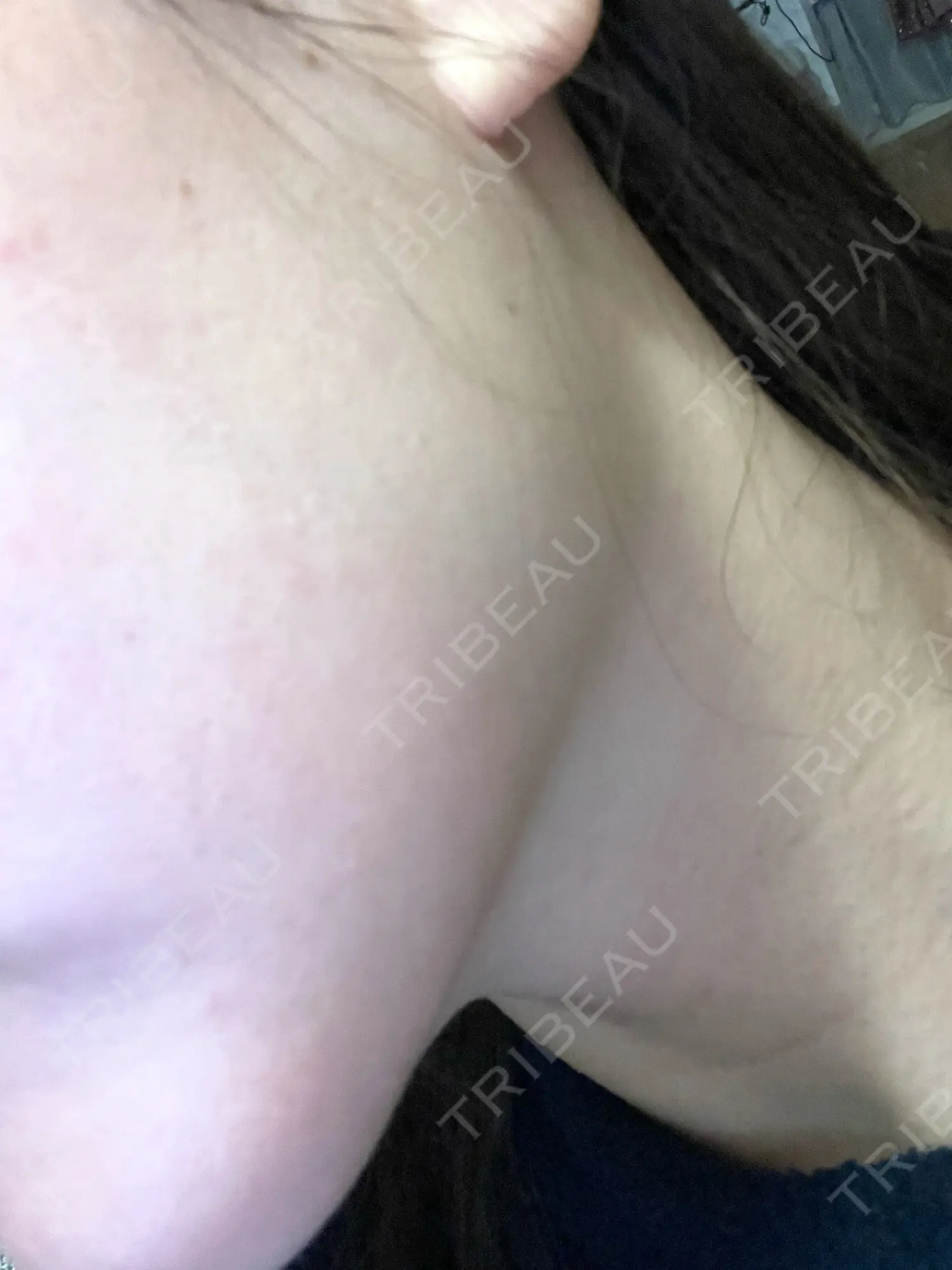 施術後の写真