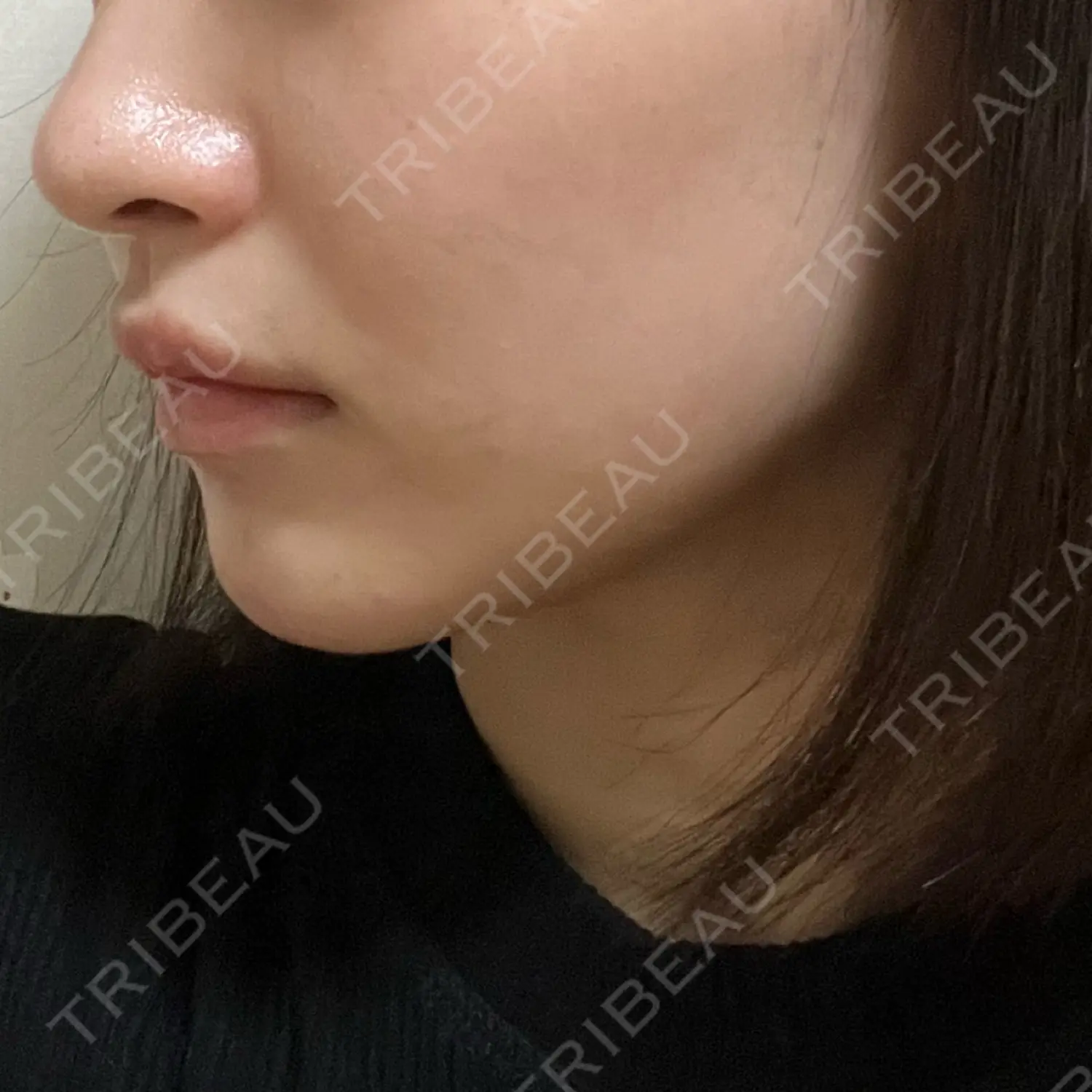 施術後の写真