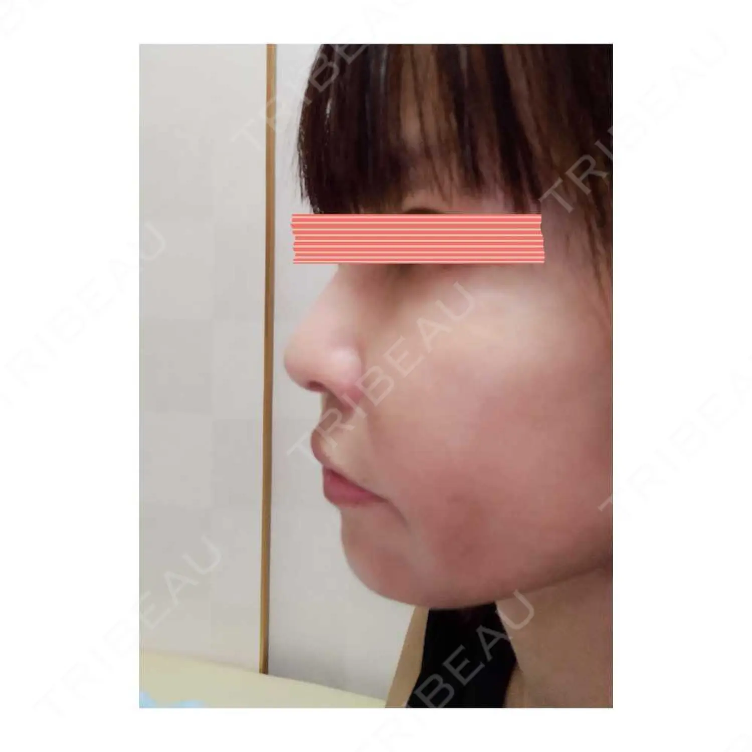 施術後の写真